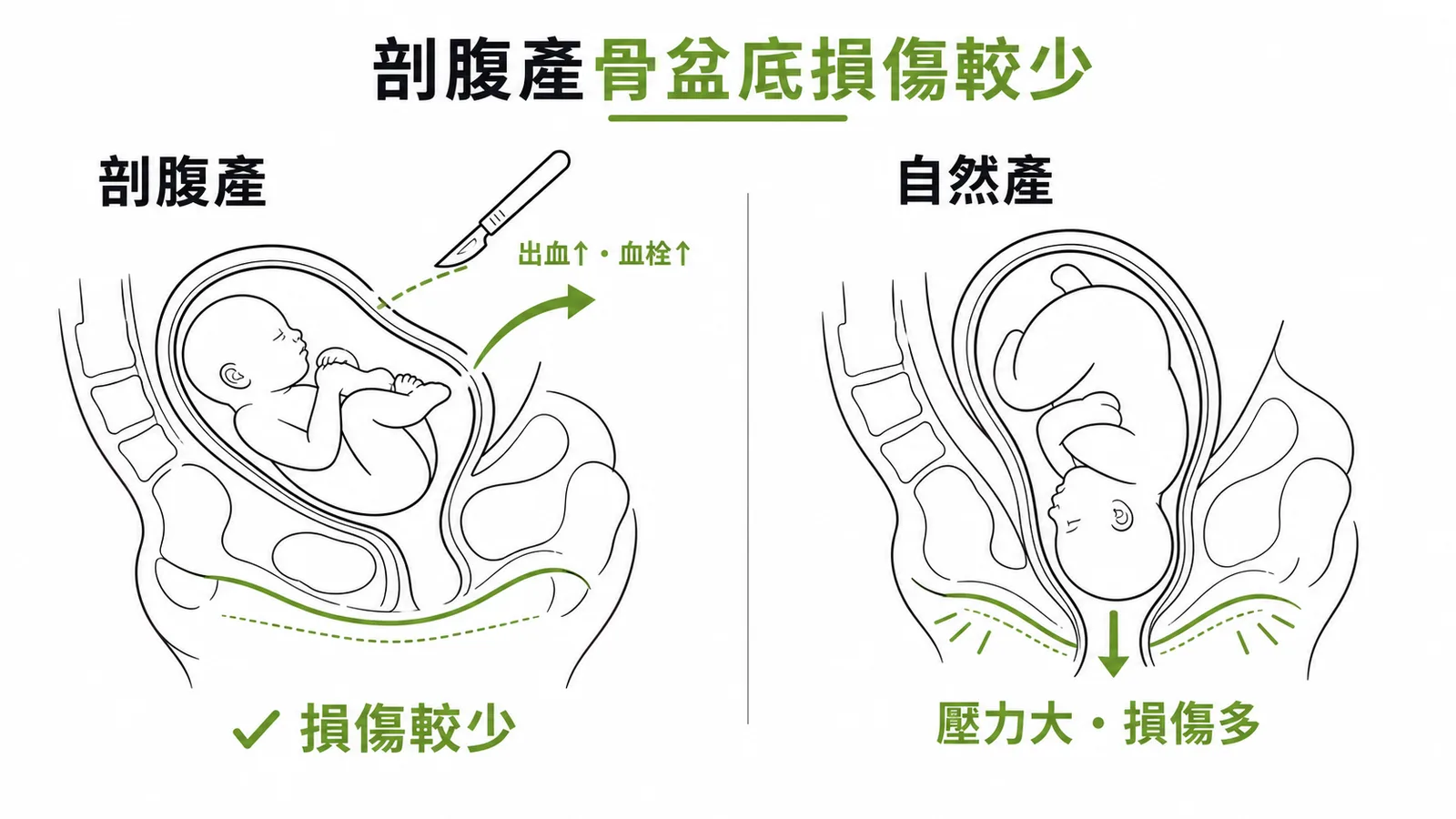 剖腹產與自然產骨盆底損傷對比示意圖