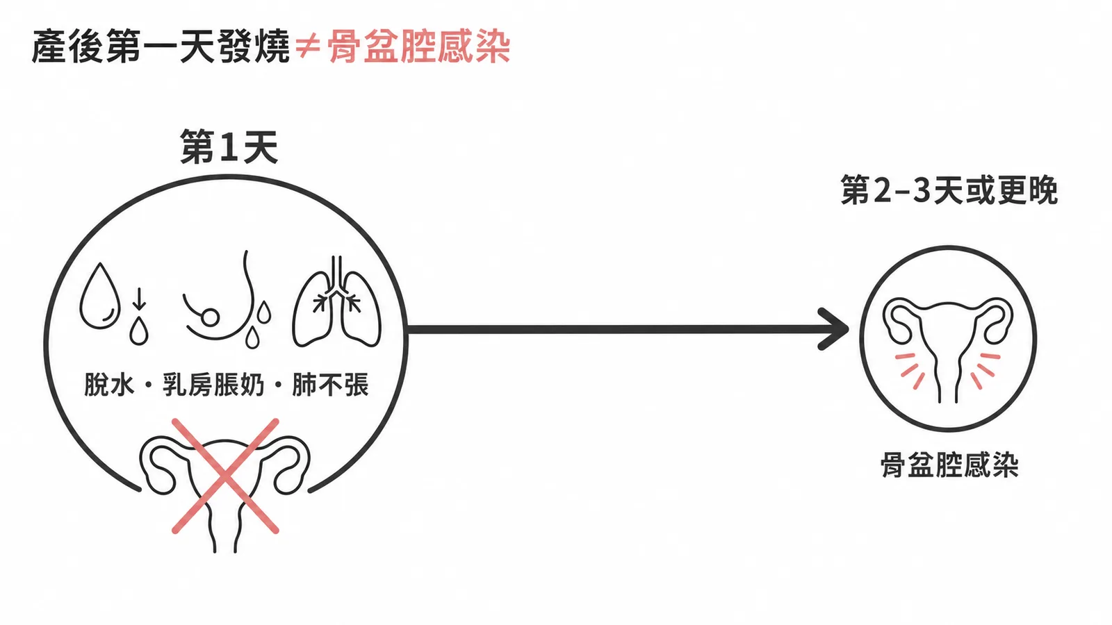 產後第一天發燒原因與骨盆腔感染時間差示意圖