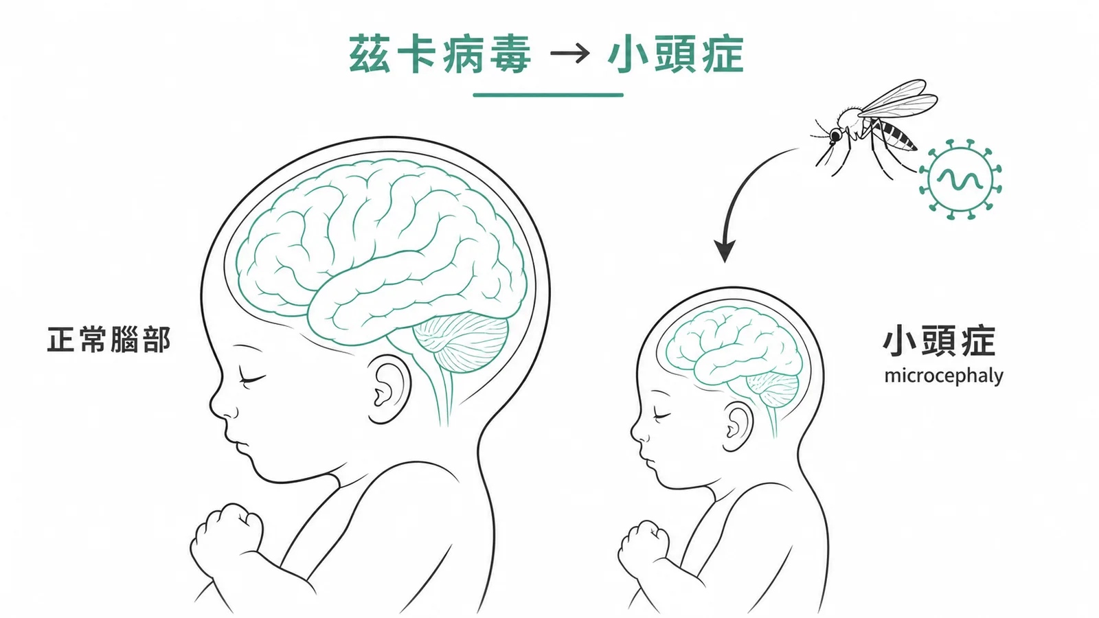 茲卡病毒導致小頭症對比示意圖