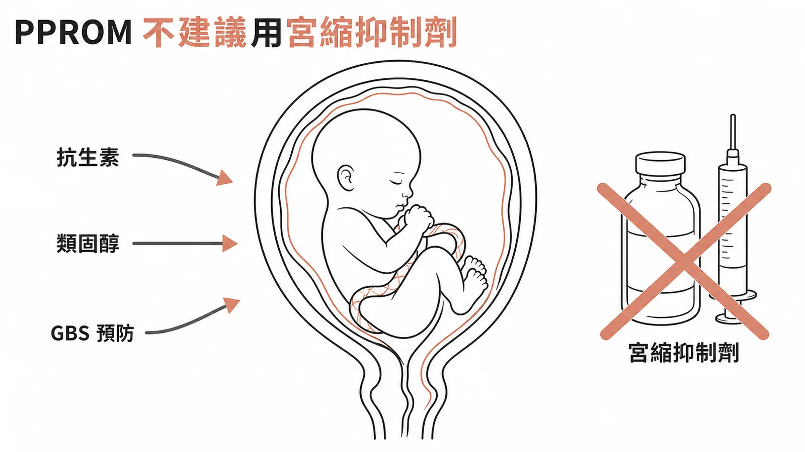 早產性羊膜早破時不建議使用宮縮抑制劑,應以抗生素、類固醇、GBS預防為主