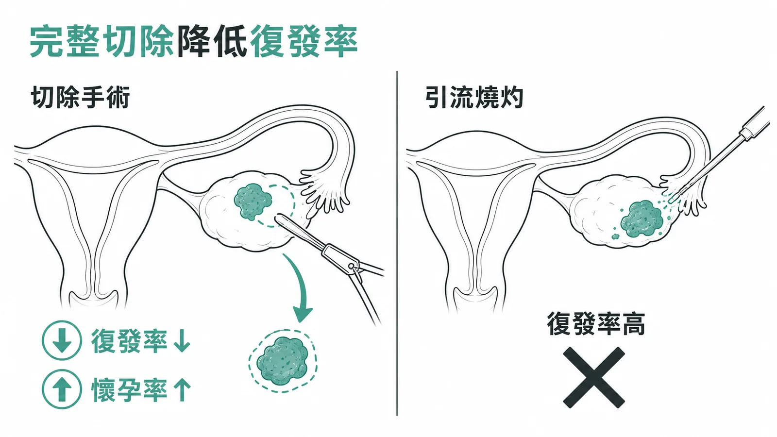 子宮內膜異位症切除手術降低復發率,引流燒灼復發率較高