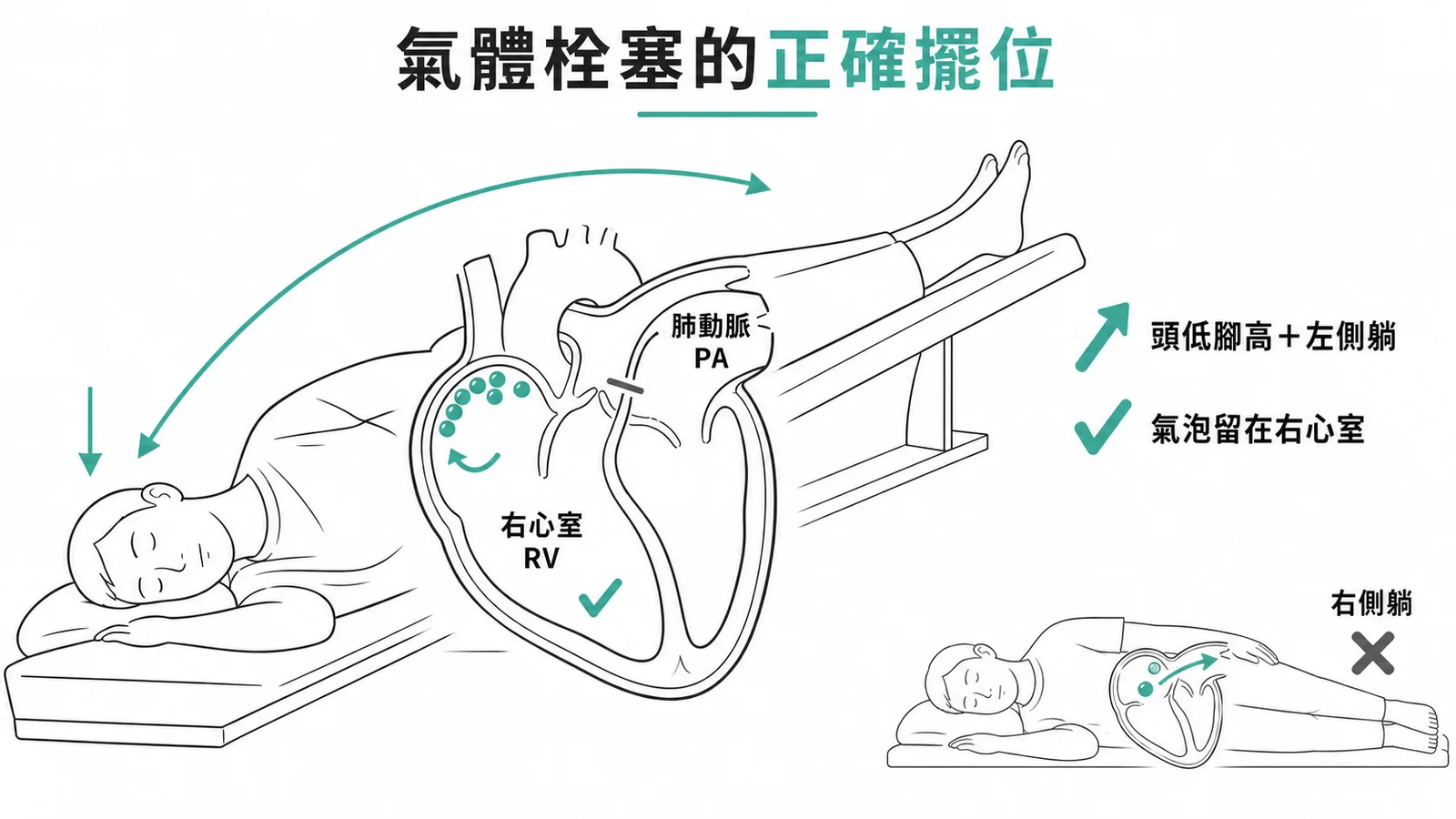 氣體栓塞時應頭低腳高加左側躺，讓氣泡聚於右心室頂部，右側躺會使氣體進入肺動脈