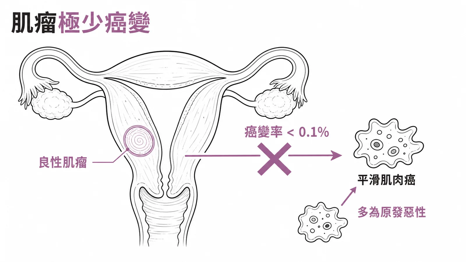 子宮肌瘤癌變為平滑肌肉癌的機率極低,不到百分之零點一