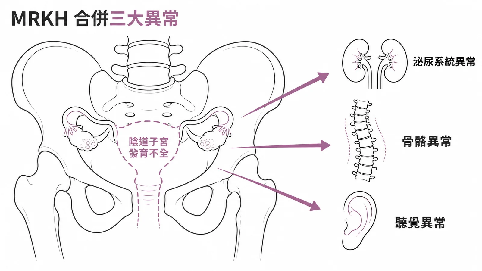 MRKH症候群常合併泌尿系統、骨骼及聽覺三大先天異常