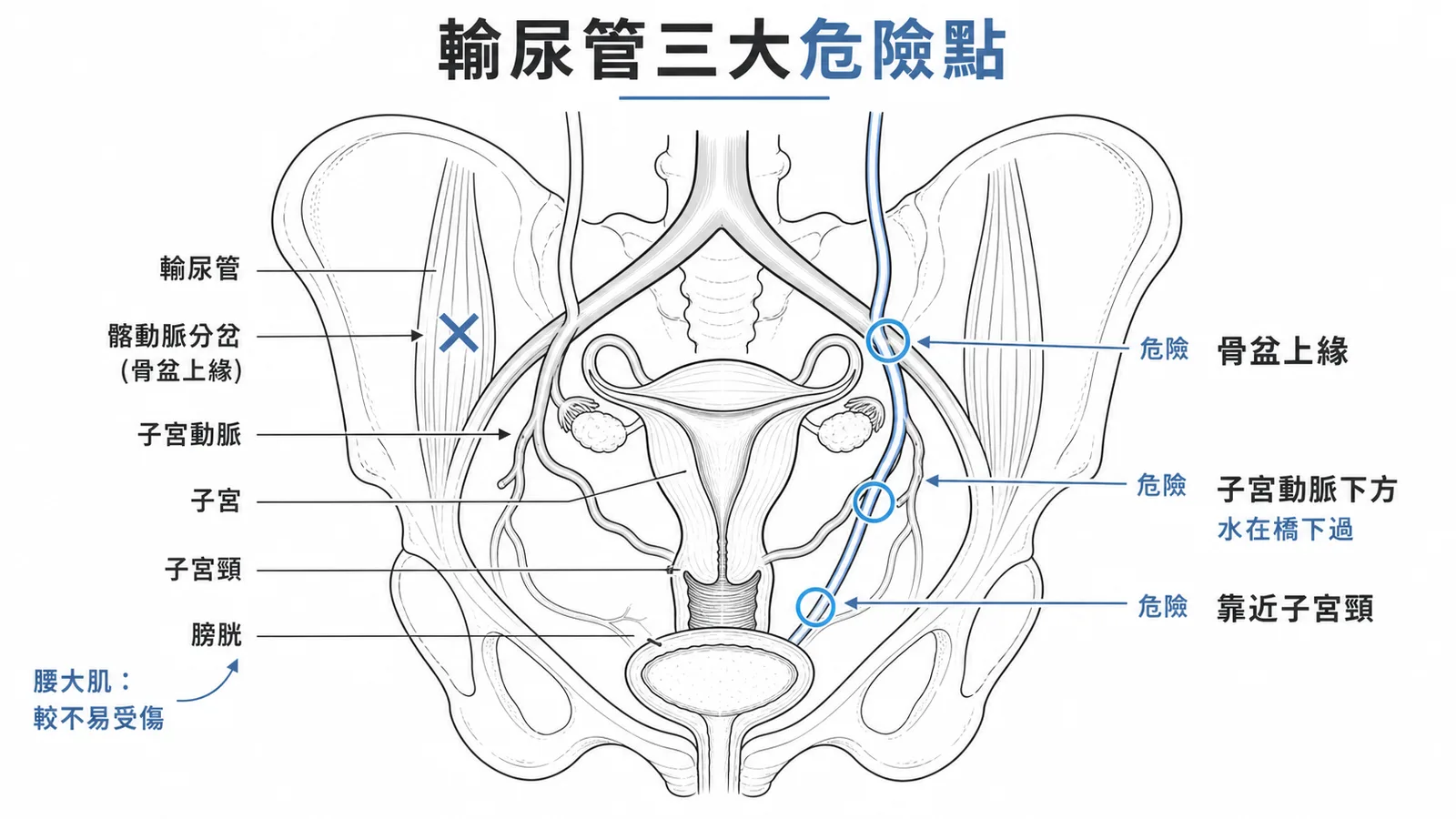 子宮切除術中輸尿管在骨盆上緣、子宮動脈下方及靠近子宮頸處最易受傷