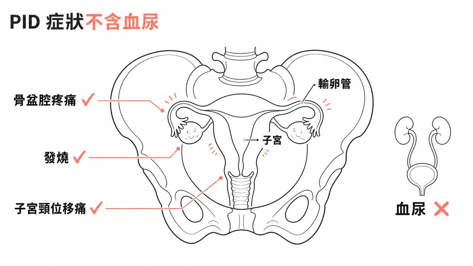 骨盆腔發炎常見症狀為骨盆腔疼痛、發燒、子宮頸位移痛,血尿不屬於PID症狀
