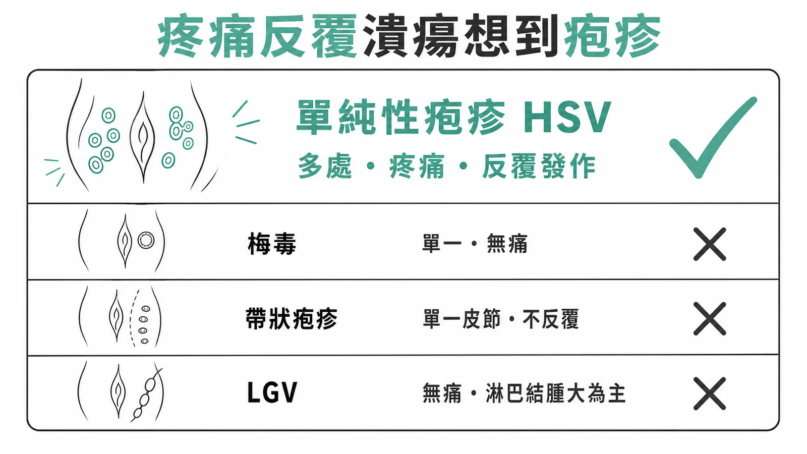外陰部反覆疼痛性多處潰瘍的鑑別診斷,單純性疱疹為最可能原因