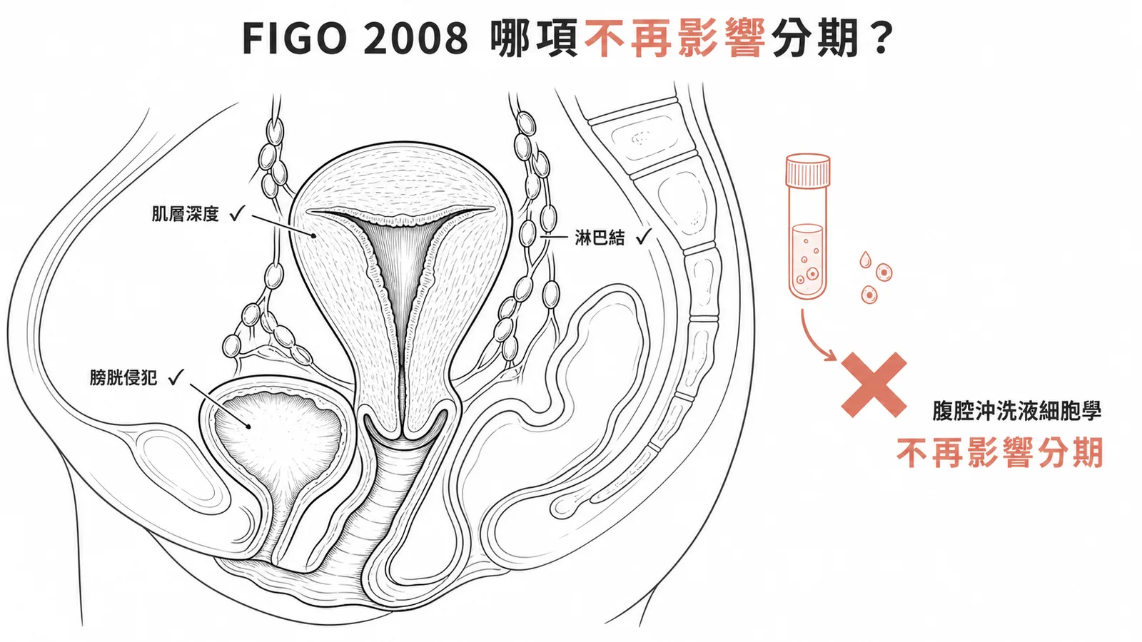 FIGO 2008 子宮內膜癌分期:腹腔沖洗液細胞學不再影響期別
