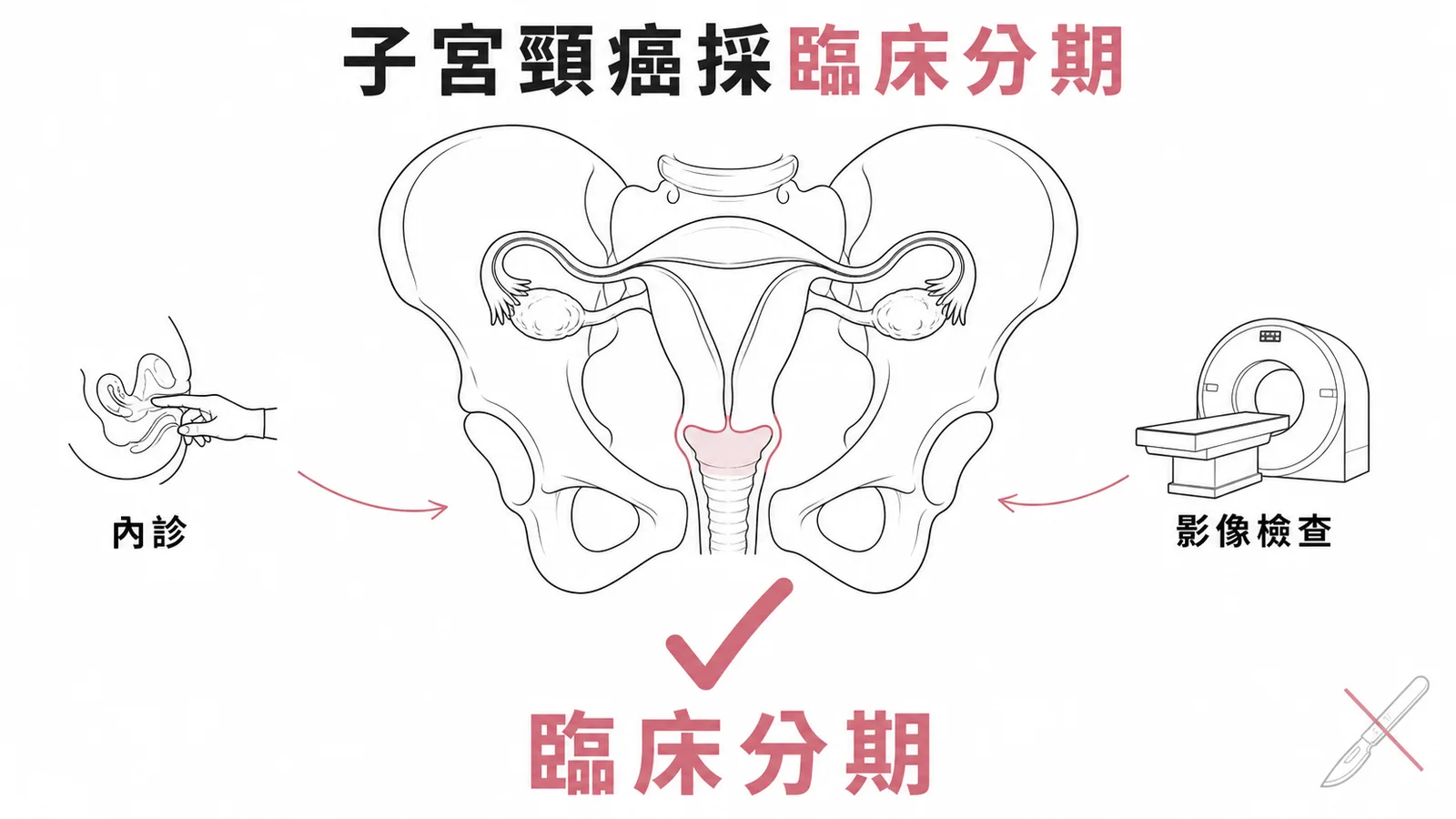 子宮頸癌採臨床分期而非手術分期,依據內診與影像檢查結果