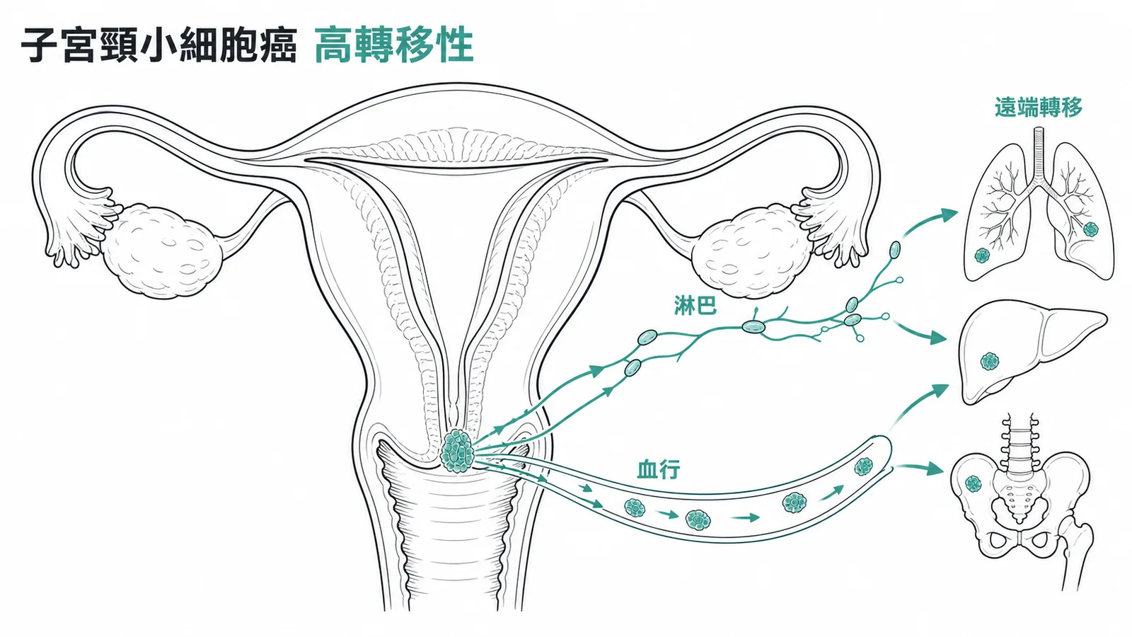子宮頸小細胞癌的高轉移特性:經淋巴與血行早期遠端轉移