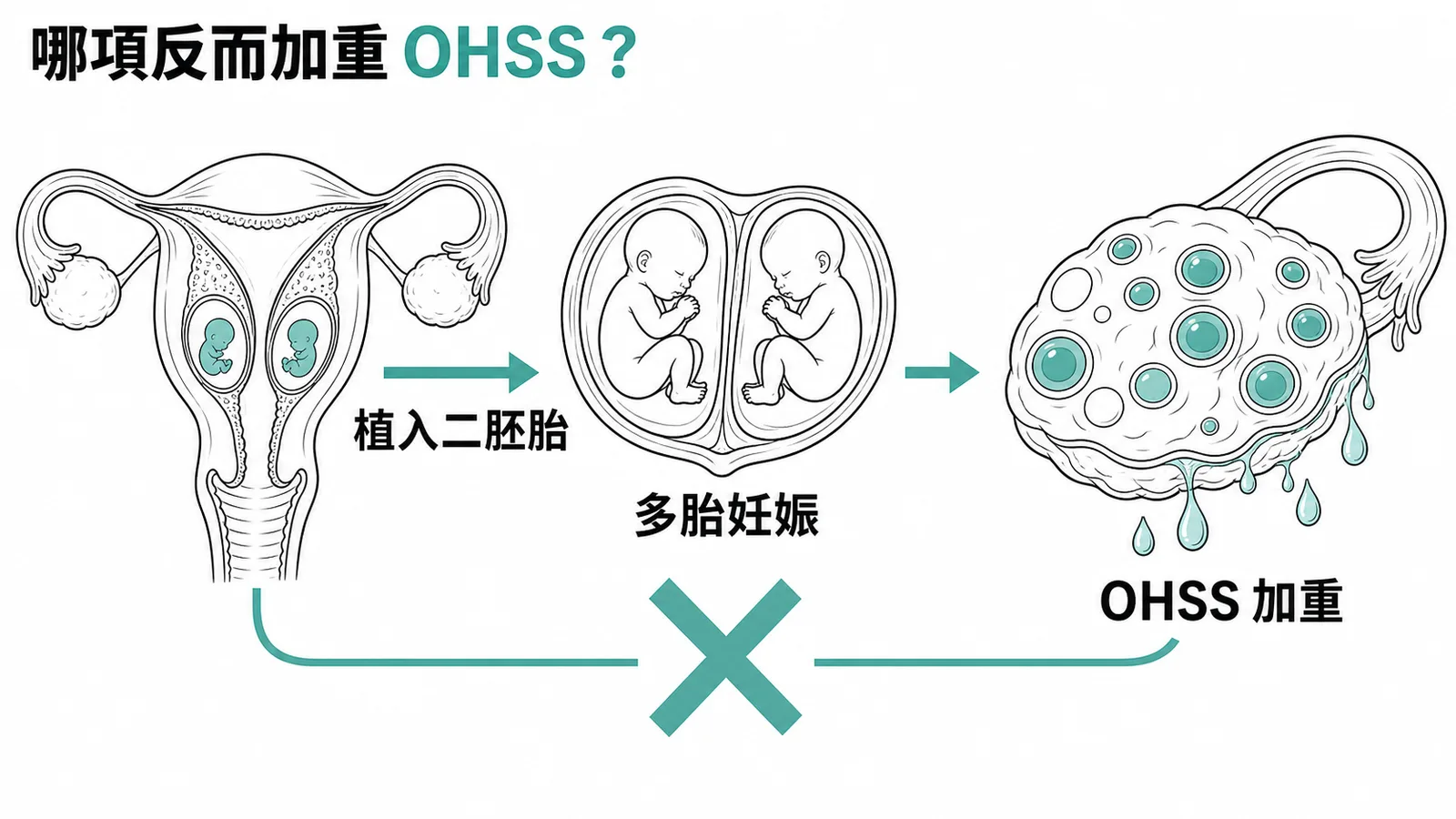 OHSS 預防:植入二胚胎反而增加多胎妊娠風險加重 OHSS