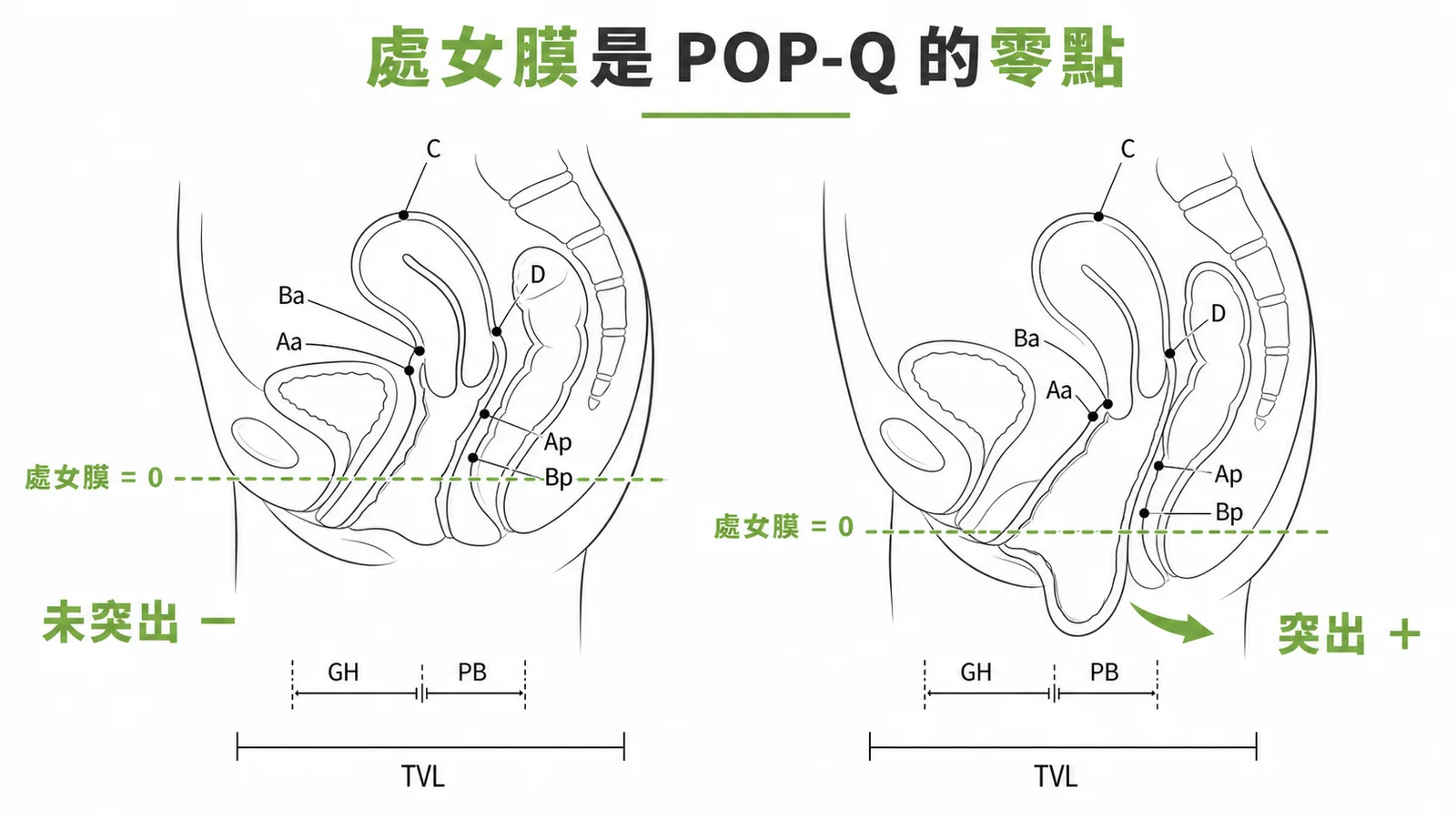 POP-Q 九個測量值:以處女膜為零點,六解剖點加三距離