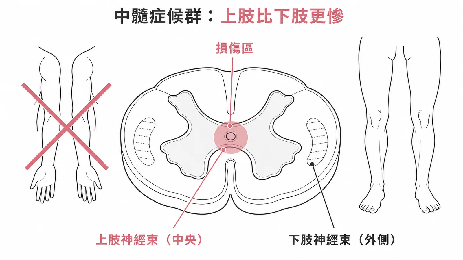 中髓症候群脊髓橫切面：中央損傷導致上肢神經束受損比外側下肢神經束嚴重
