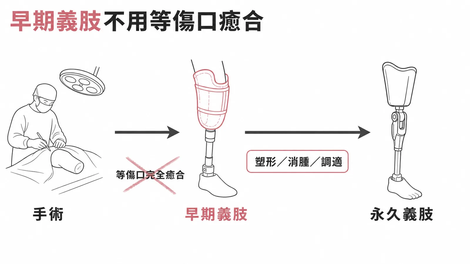 截肢復健時間線：早期義肢術後不久即可開始，不需等傷口完全癒合