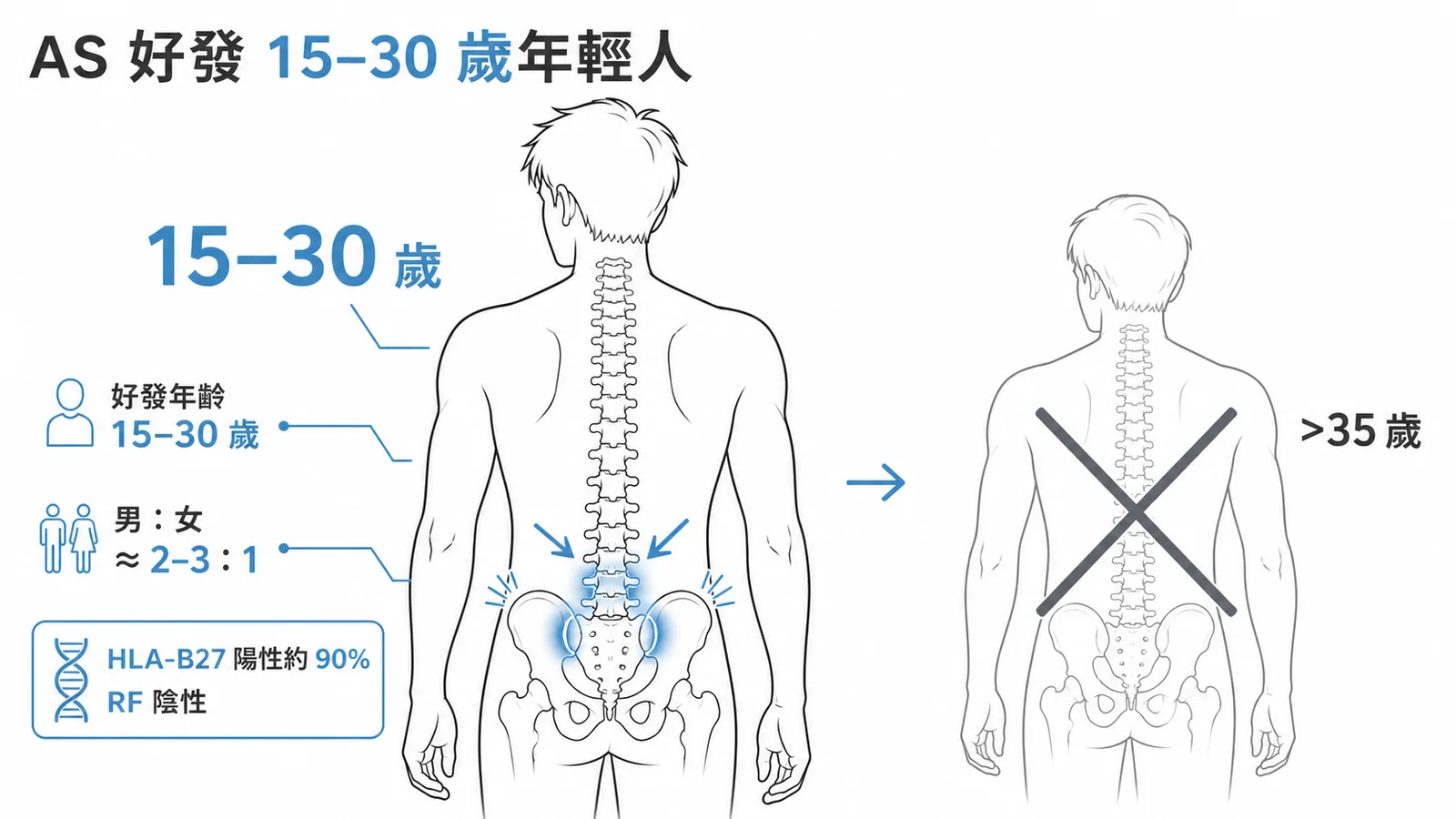 僵直性脊椎炎好發15-30歲年輕人，男女比2-3:1，HLA-B27約90%陽性