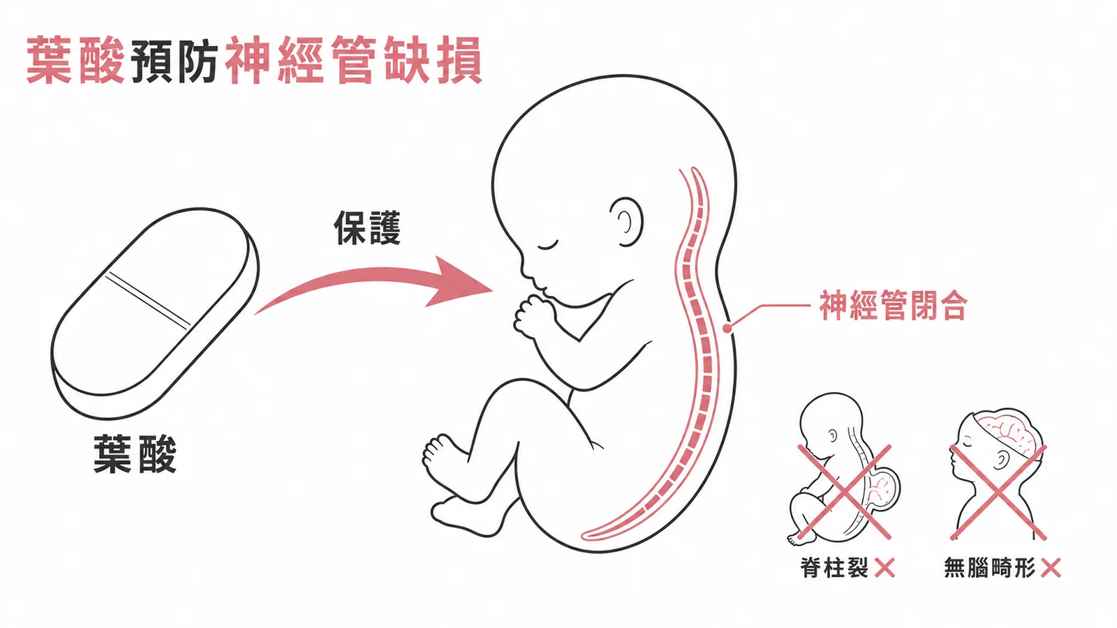 葉酸補充保護胎兒神經管正常閉合,預防脊柱裂與無腦畸形