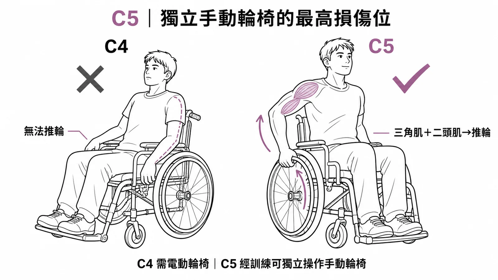 C5是能獨立操作手動輪椅的最高位頸椎損傷，C4以上需電動輪椅