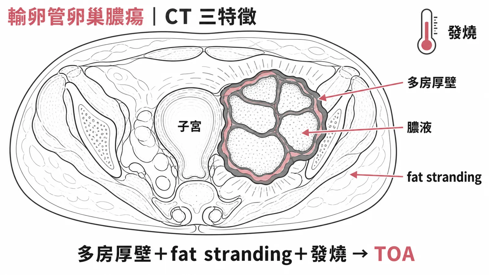 輸卵管卵巢膿瘍CT三特徵:多房厚壁、fat stranding、發燒