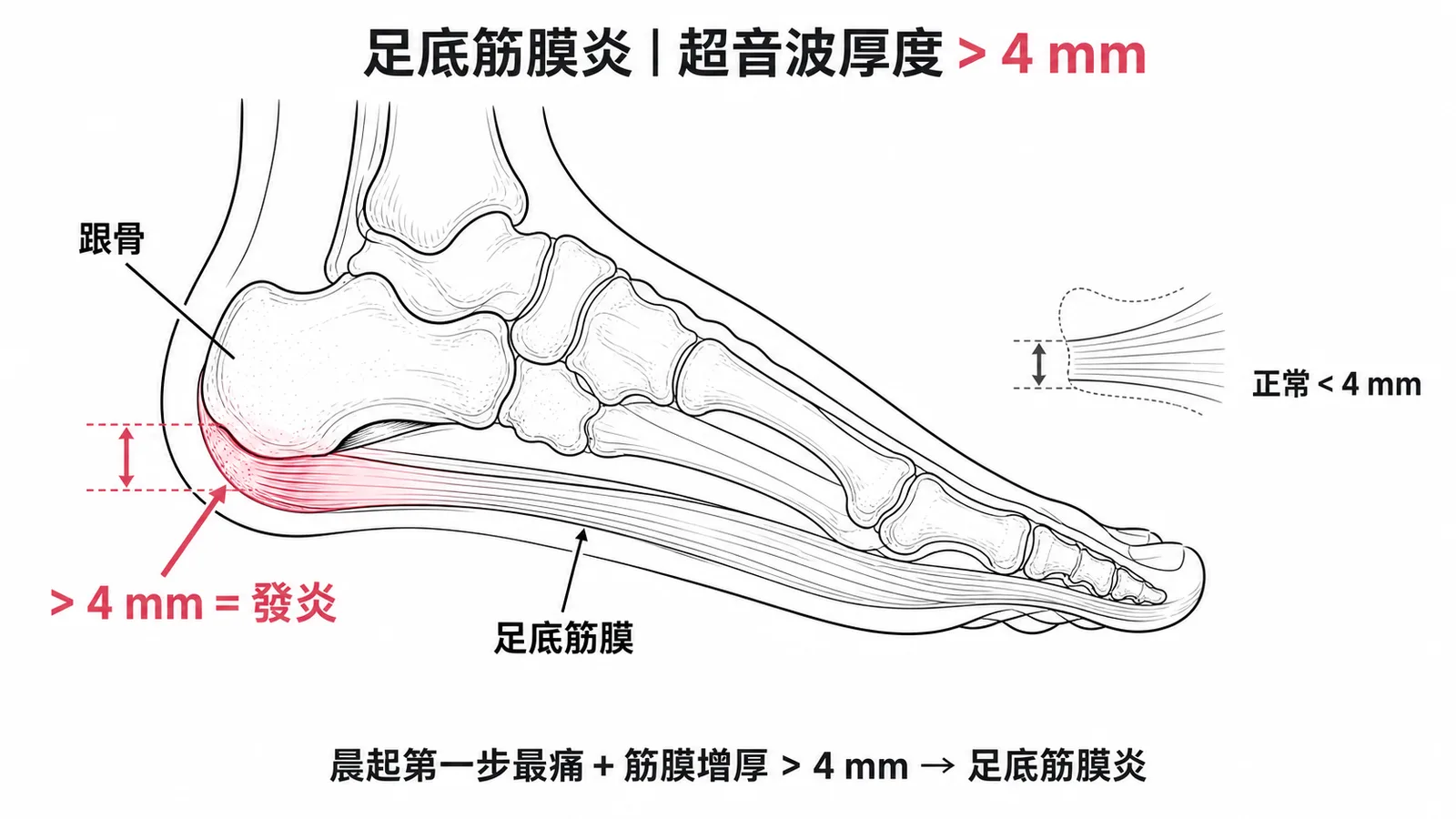 足底筋膜炎超音波特徵：跟骨附著處筋膜增厚超過4mm