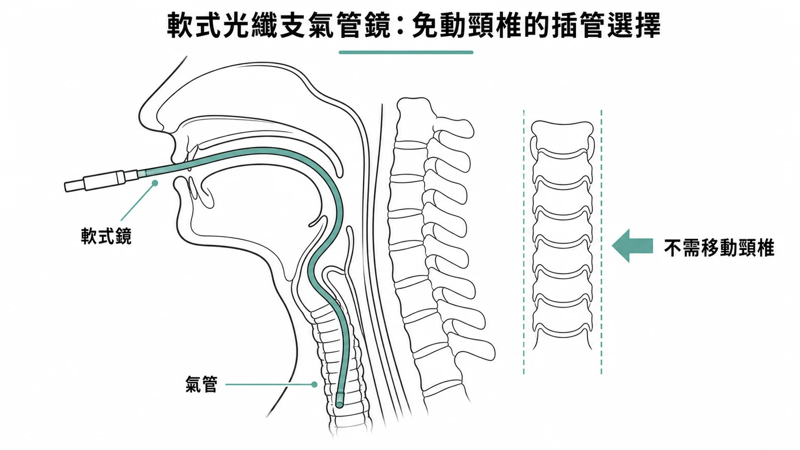 軟式光纖支氣管鏡不需移動頸椎即可完成氣管插管