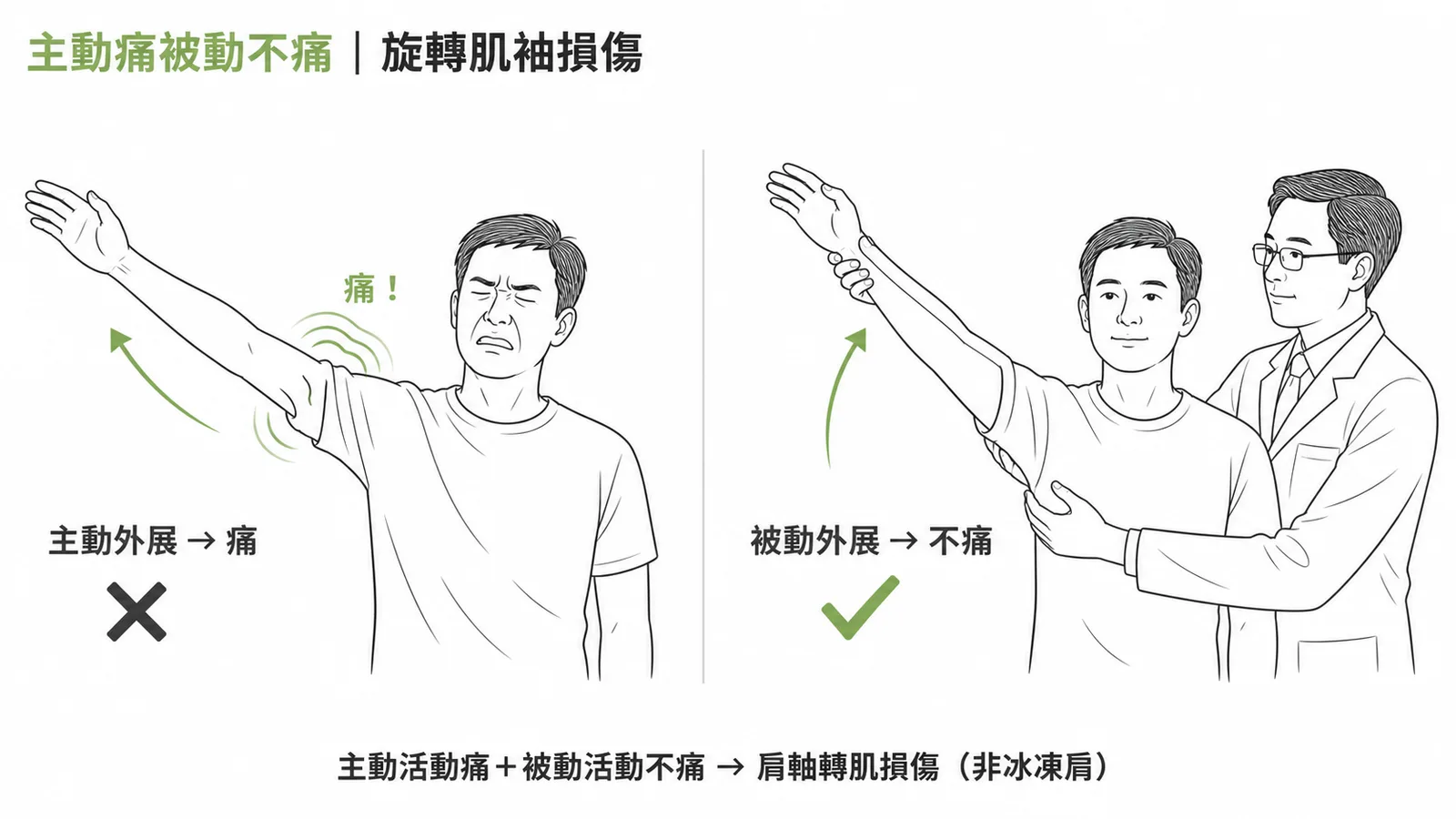 主動活動痛但被動活動不痛是肩軸轉肌損傷的鑑別特徵