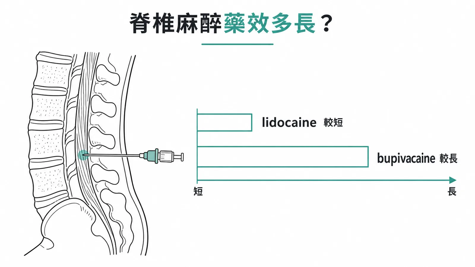 脊椎麻醉中 bupivacaine 作用時間比 lidocaine 長