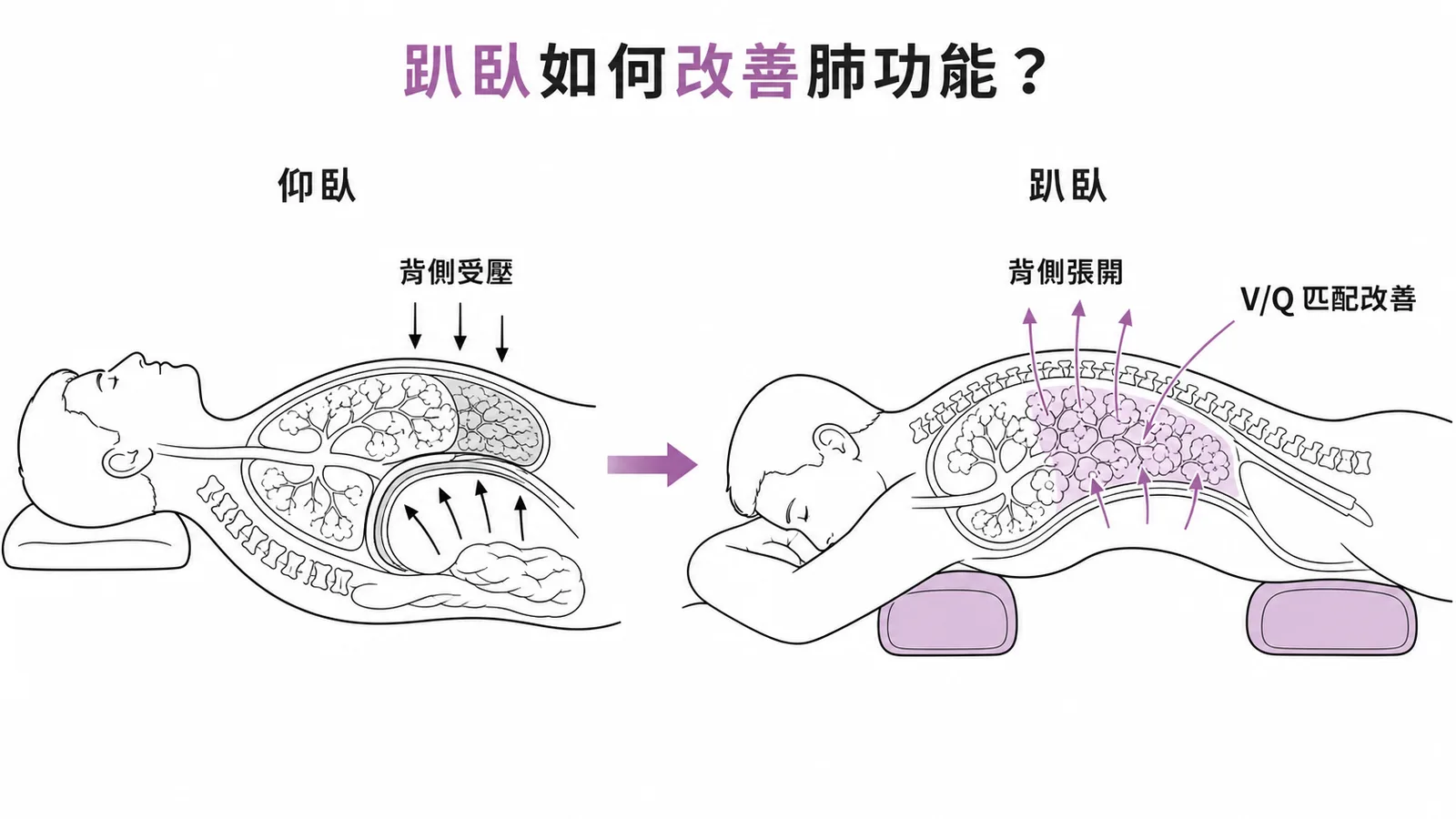 趴臥姿勢改善背側肺通氣，提升 V/Q 匹配