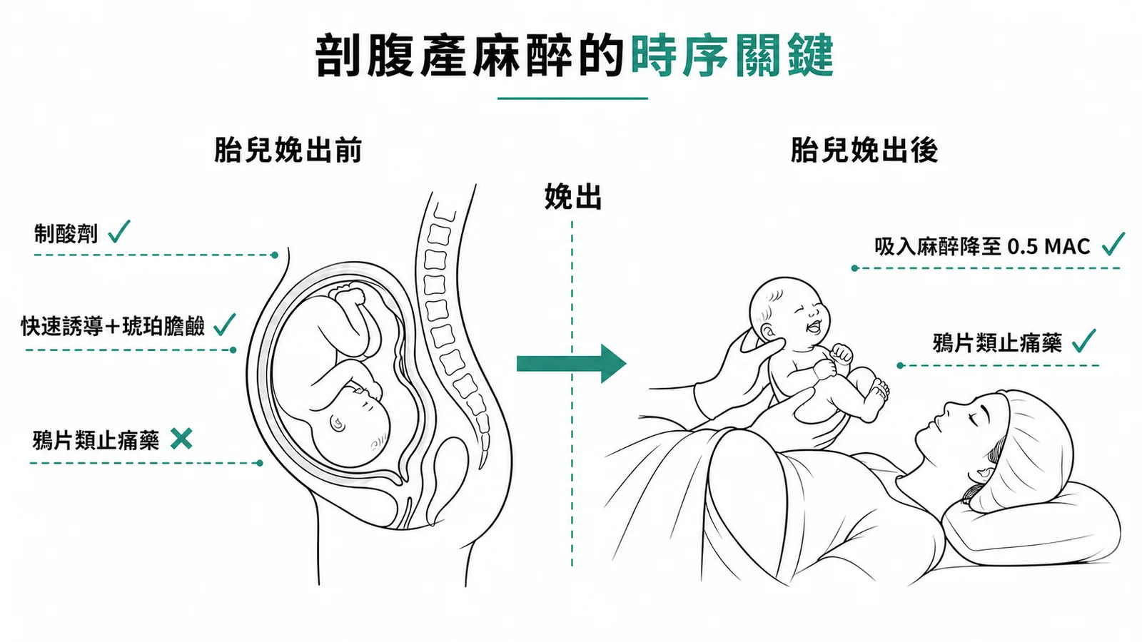 剖腹產全麻時序：胎兒娩出前後用藥原則不同