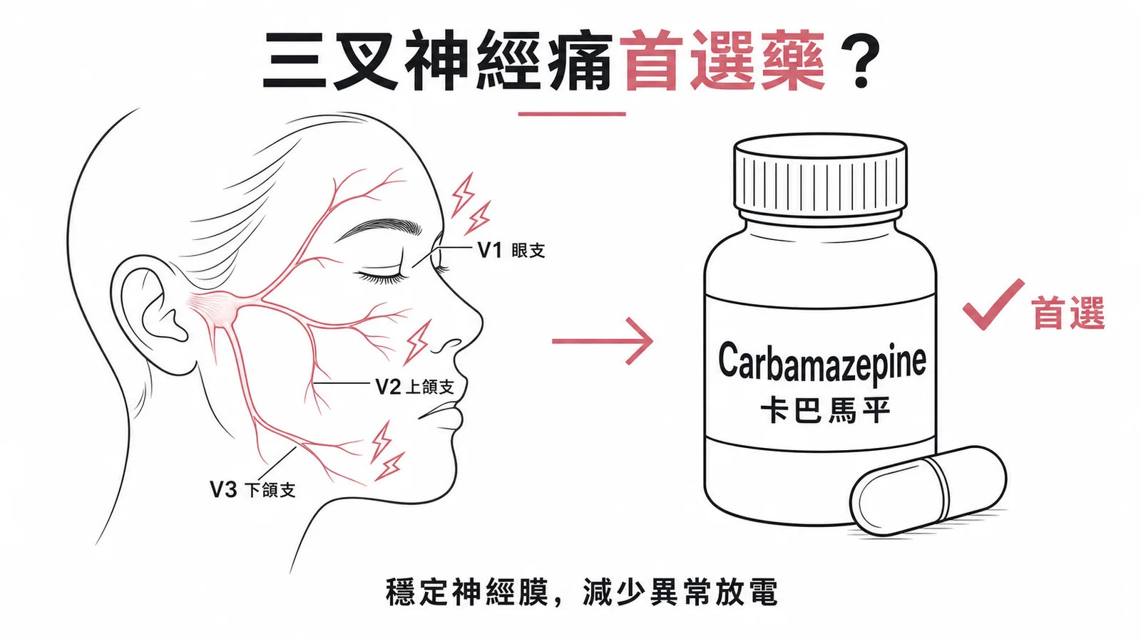三叉神經痛首選藥物 Carbamazepine，穩定神經膜減少異常放電