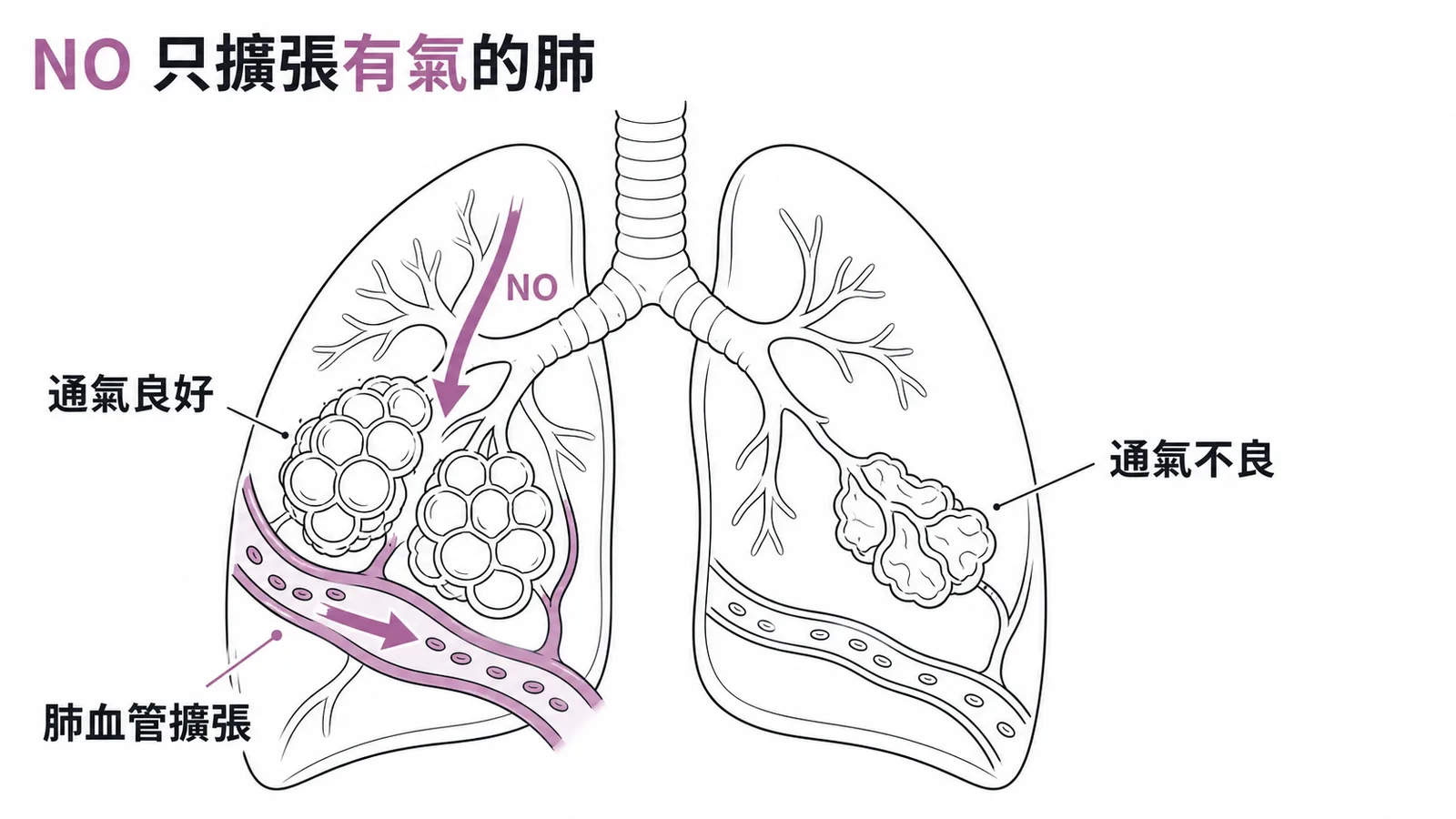 吸入性 NO 選擇性擴張通氣良好區域的肺血管