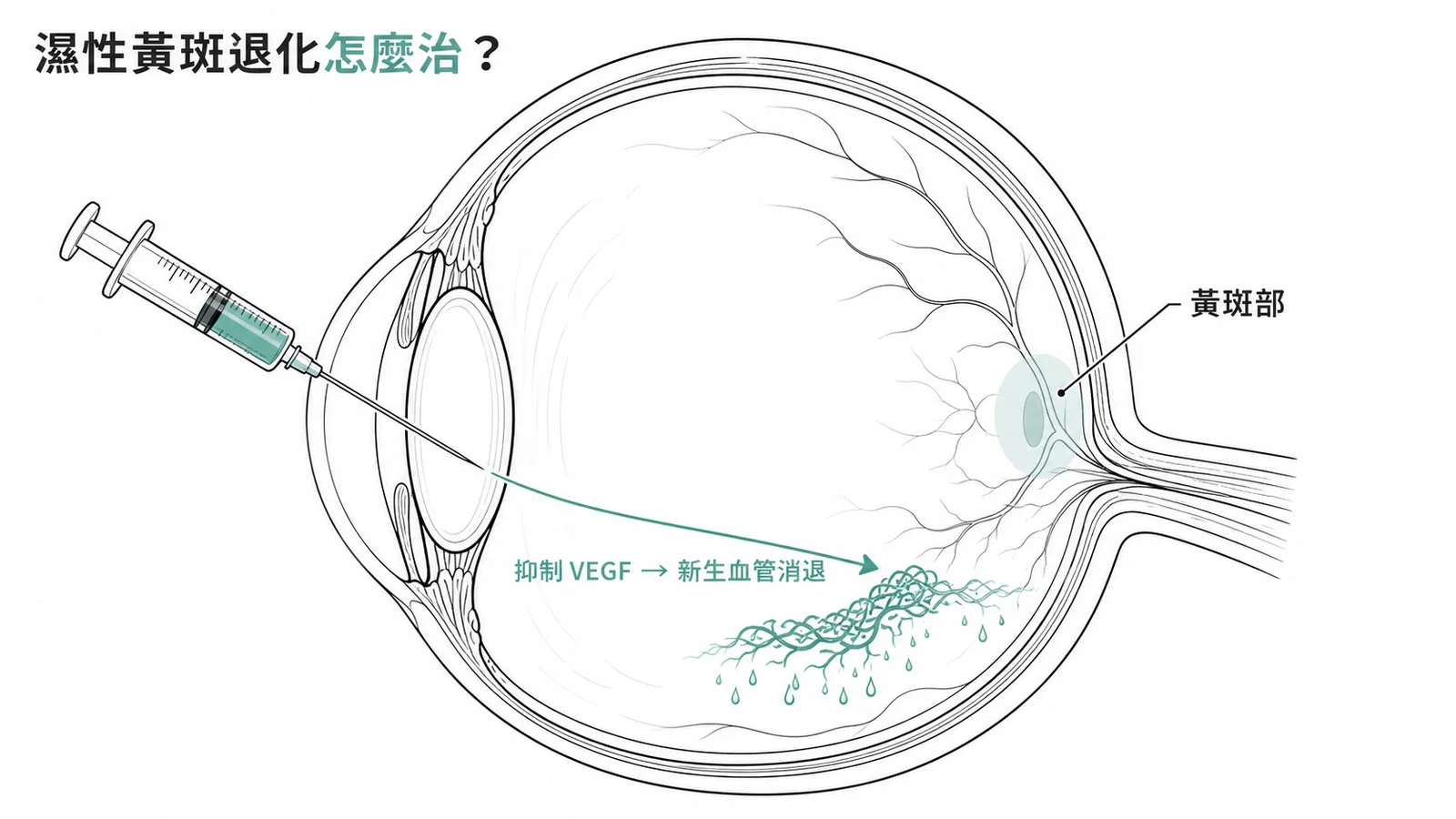 玻璃體內注射 anti-VEGF 抑制黃斑部新生血管