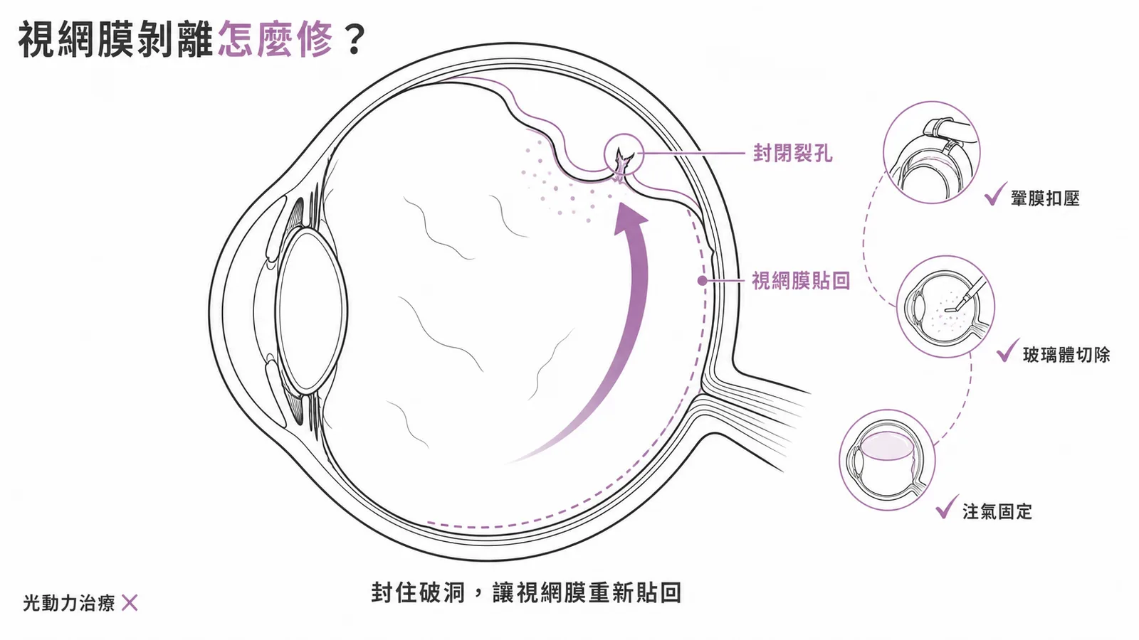 裂孔性視網膜剝離治療：封閉裂孔讓視網膜貼回，光動力治療不適用