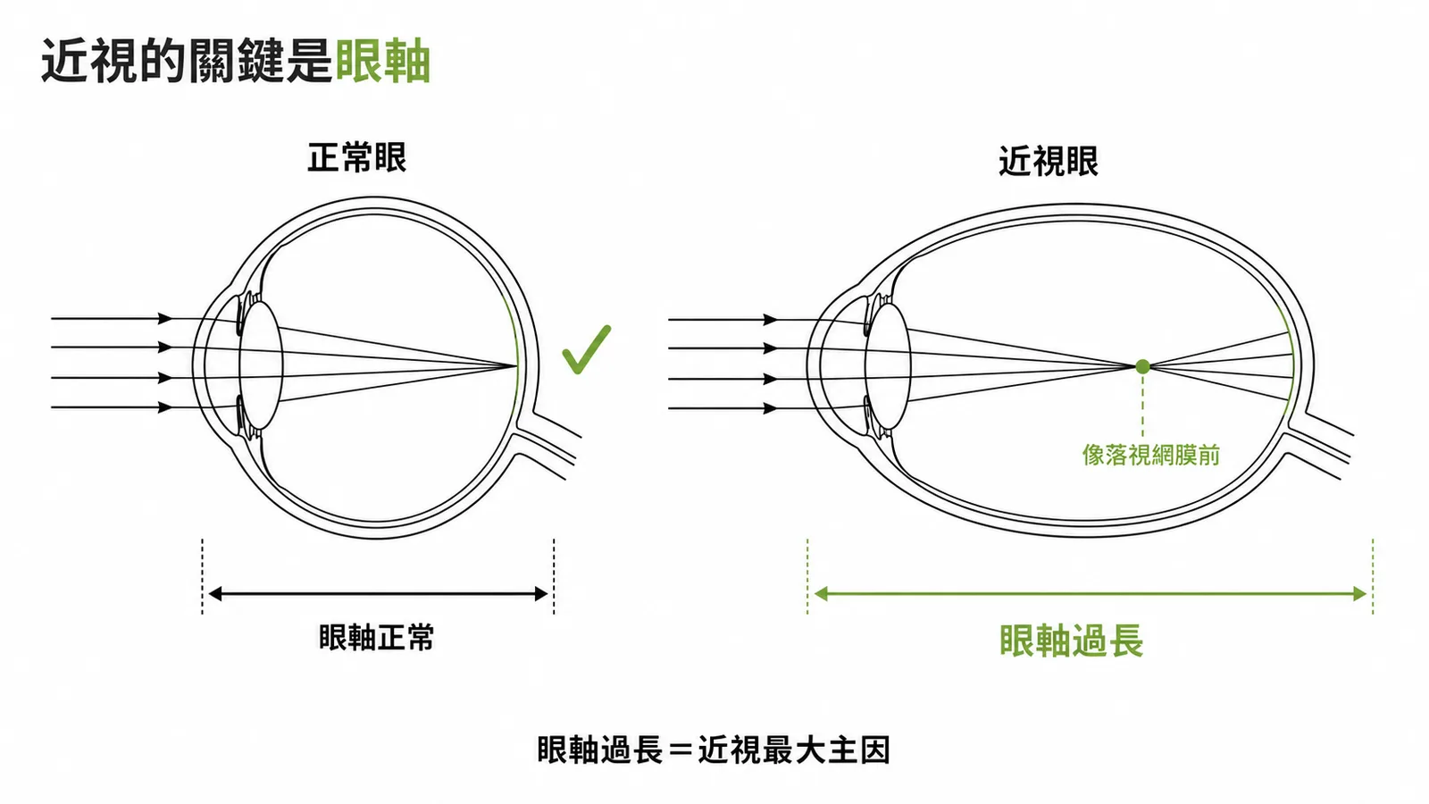 近視最主要成因是眼軸過長，光線聚焦在視網膜前方