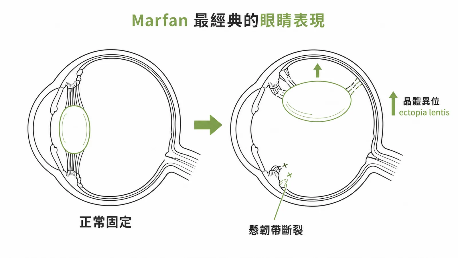 Marfan syndrome 晶體異位：懸韌帶斷裂導致晶體向上脫位