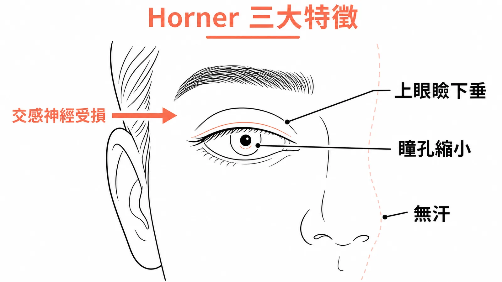 Horner syndrome 三大特徵：瞳孔縮小、上眼瞼下垂、無汗（交感神經受損）