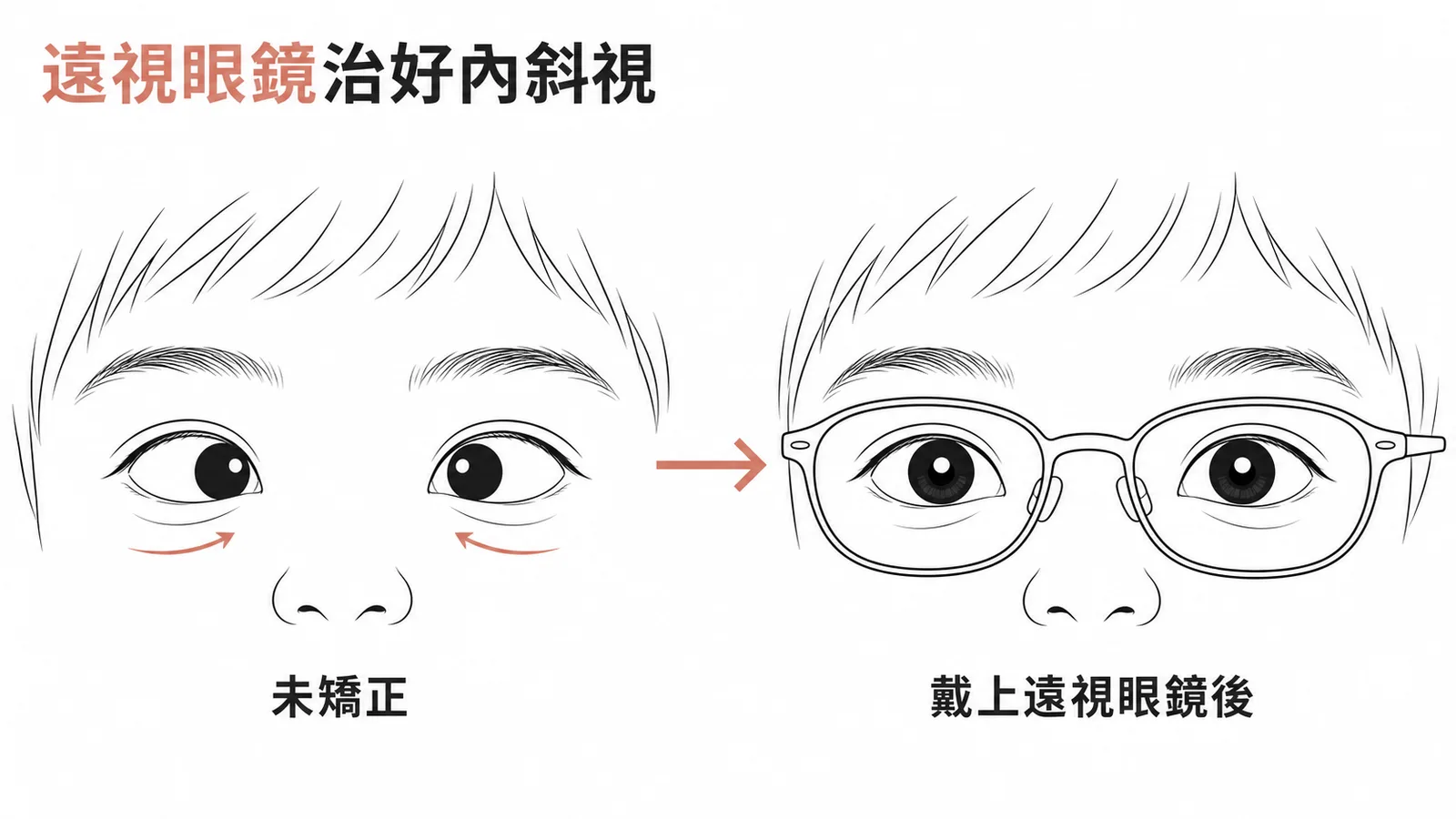 調視性內斜視：戴遠視眼鏡矯正後內斜視消失