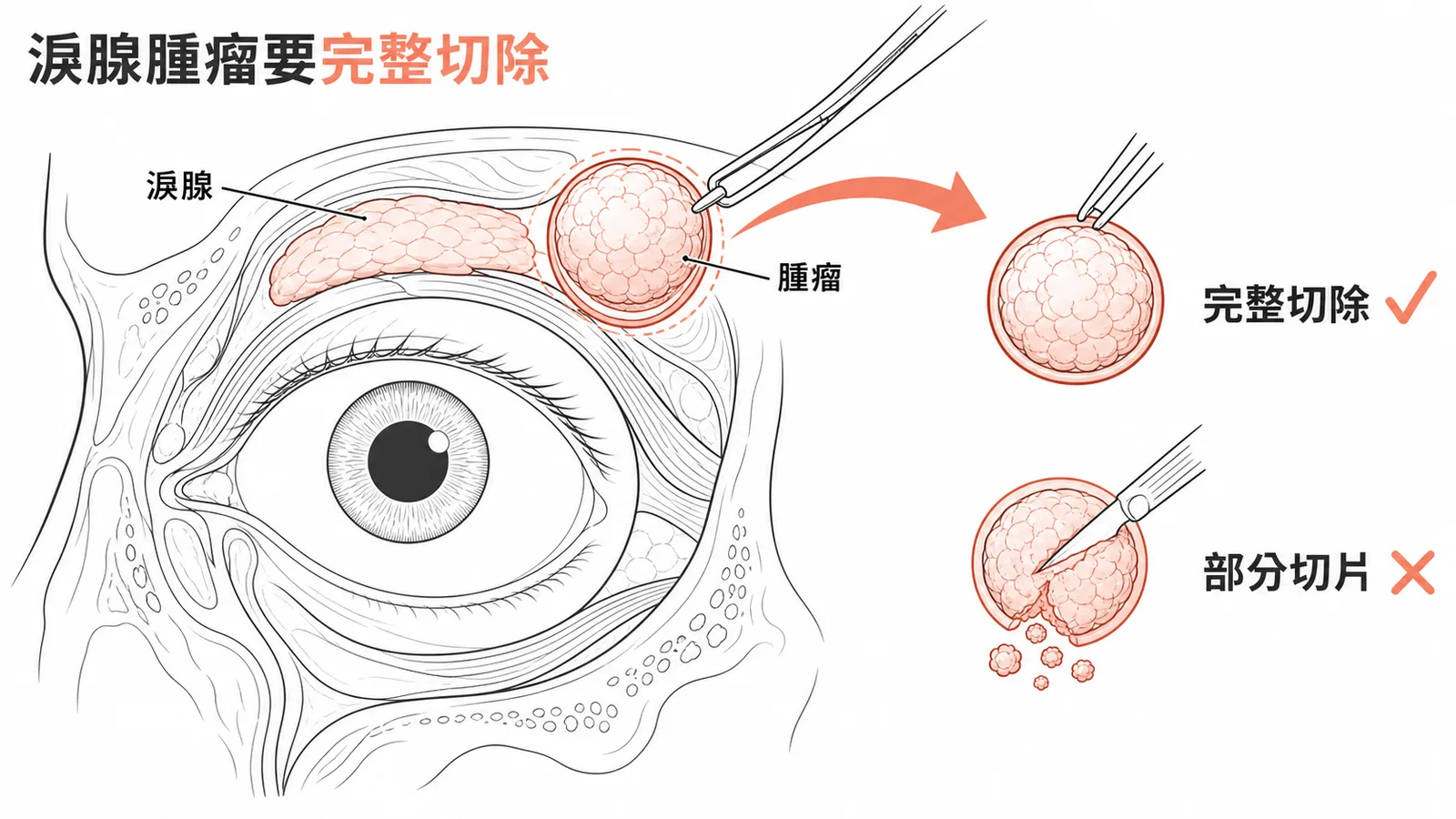 淚腺腫瘤要完整切除，不可做部分切片
