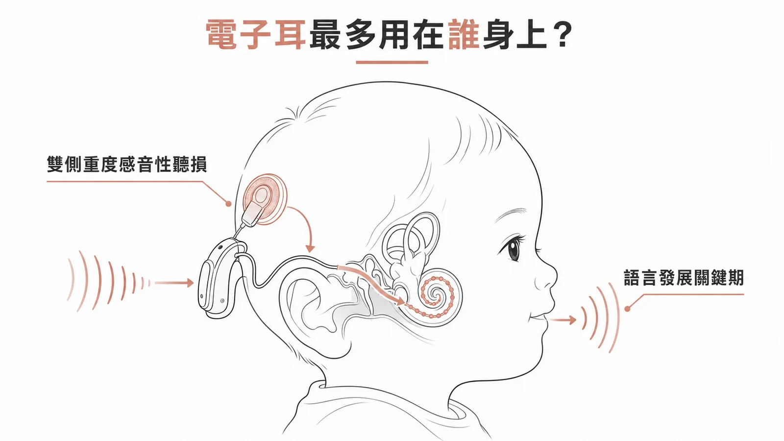 人工電子耳最常植入對象：雙側重度感音性聽損嬰幼兒