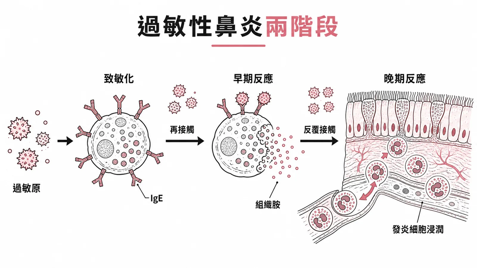過敏性鼻炎兩階段：致敏化→早期反應(組織胺)→晚期反應(發炎細胞浸潤)
