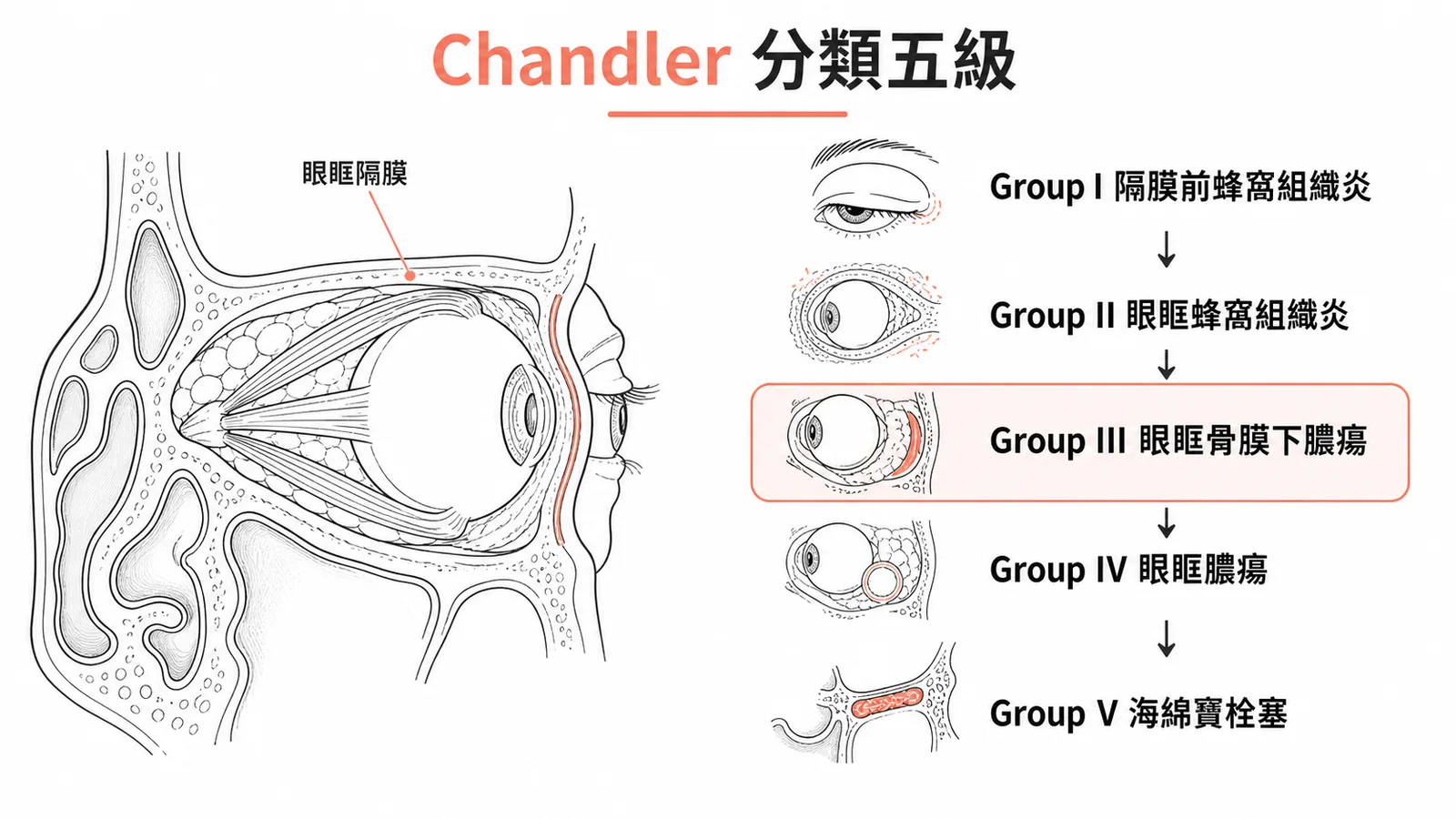 Chandler 分類五級：鼻竇炎眼部併發症由輕到重