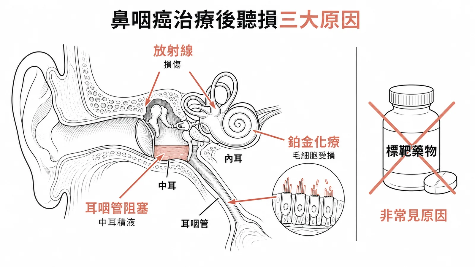 鼻咽癌治療後聽損三大原因：放射線、耳咽管阻塞、鉑金化療，標靶藥物非常見原因
