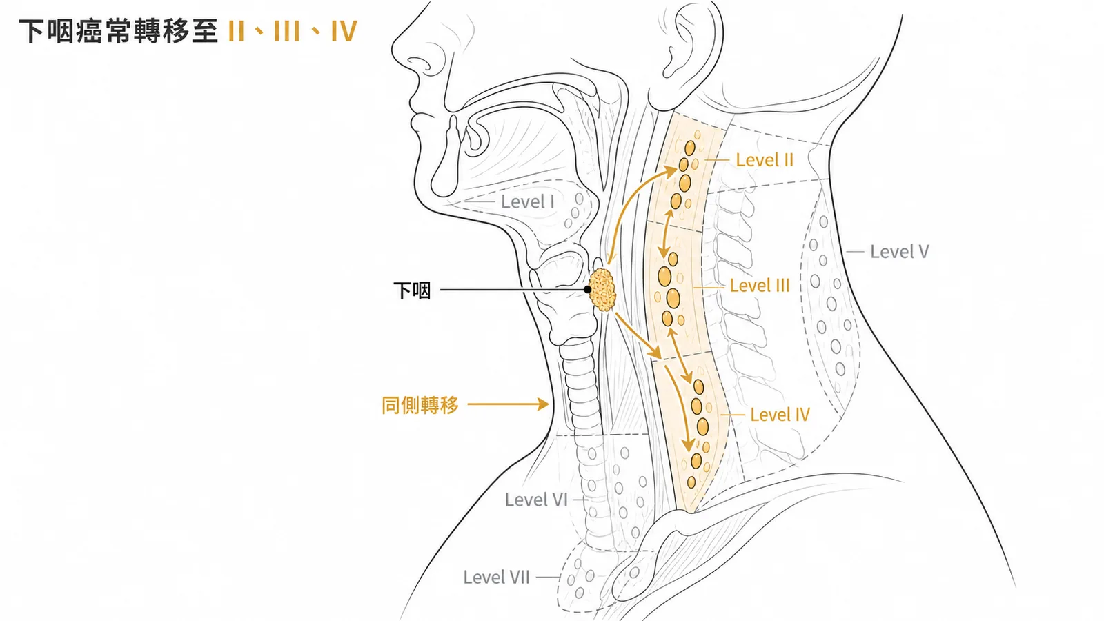 下咽癌最常轉移至同側頸部Level II、III、IV淋巴結