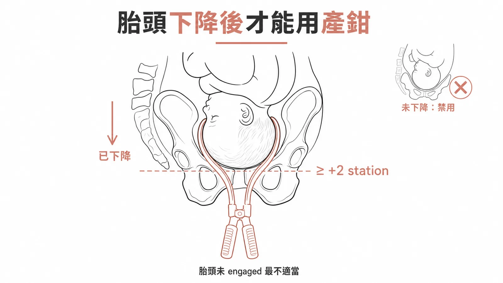 產鉗使用必須胎頭已下降至≥+2 station才可施行