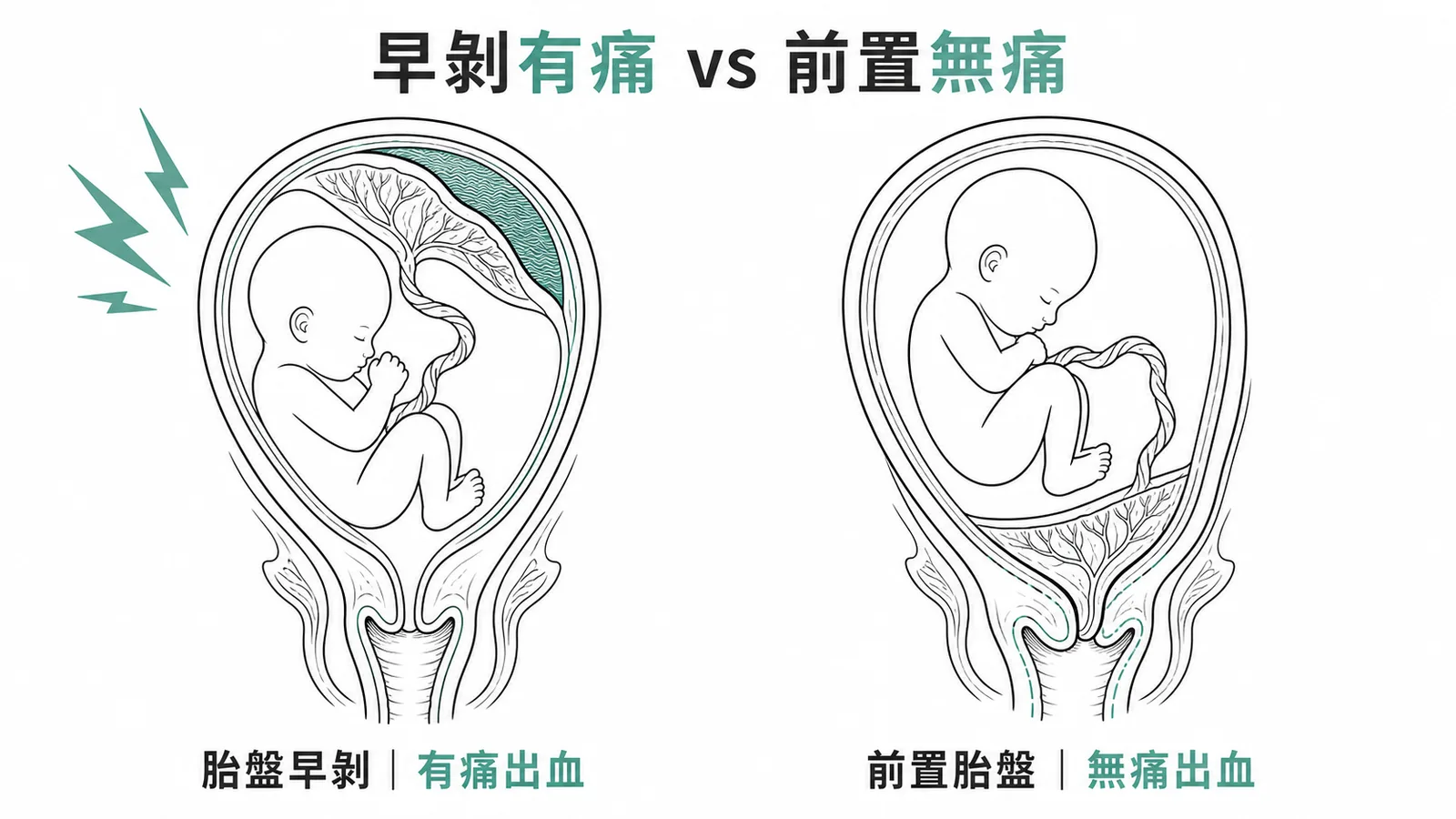 胎盤早剝為有痛性出血，前置胎盤為無痛性出血