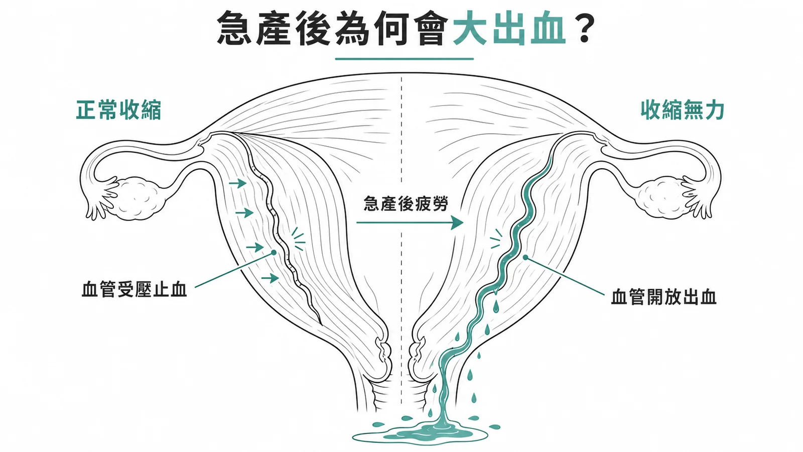 急產後子宮收縮無力導致產後出血的機轉示意圖