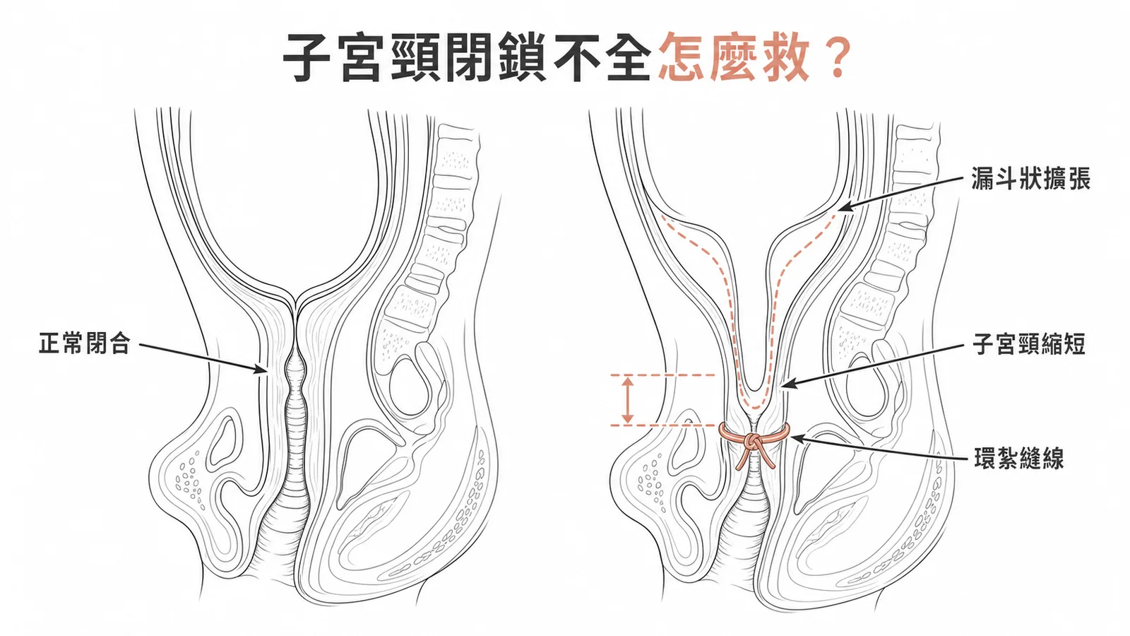 子宮頸閉鎖不全與環紮術示意圖