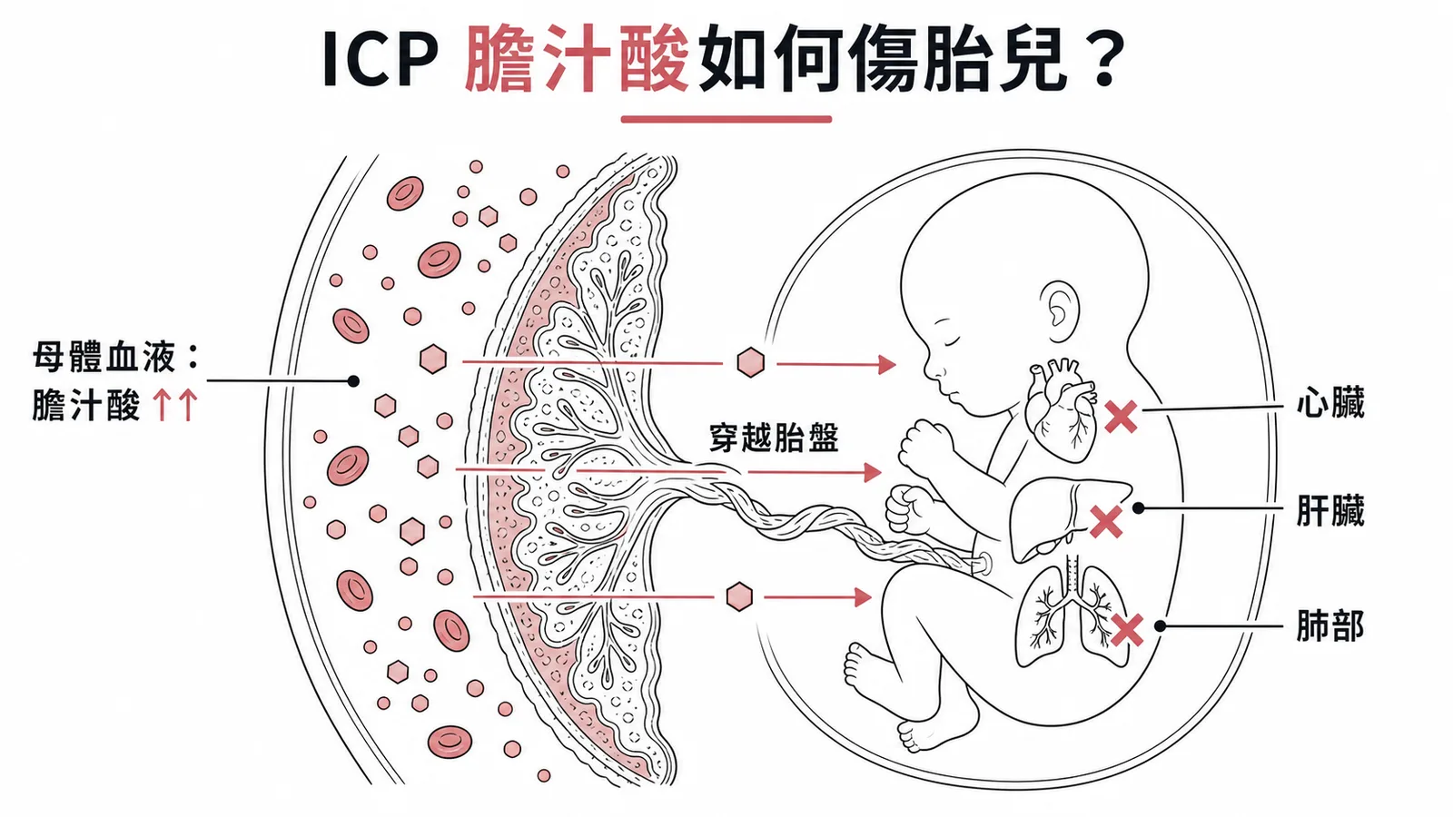 ICP膽汁酸穿越胎盤對胎兒器官造成毒性的機轉示意圖