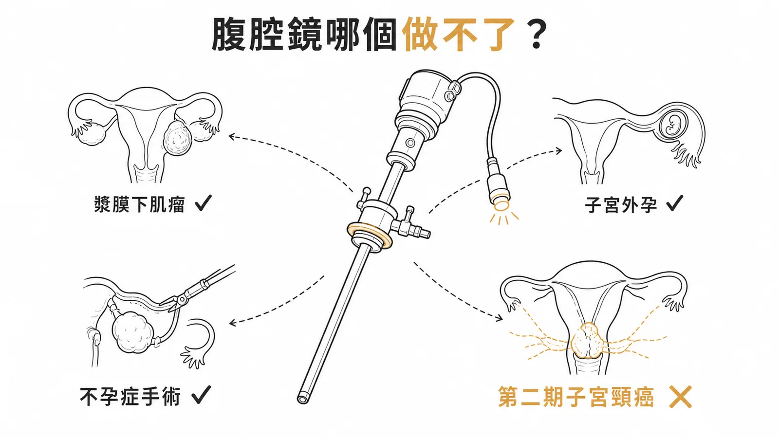 腹腔鏡適應症與第二期子宮頸癌不適用示意圖