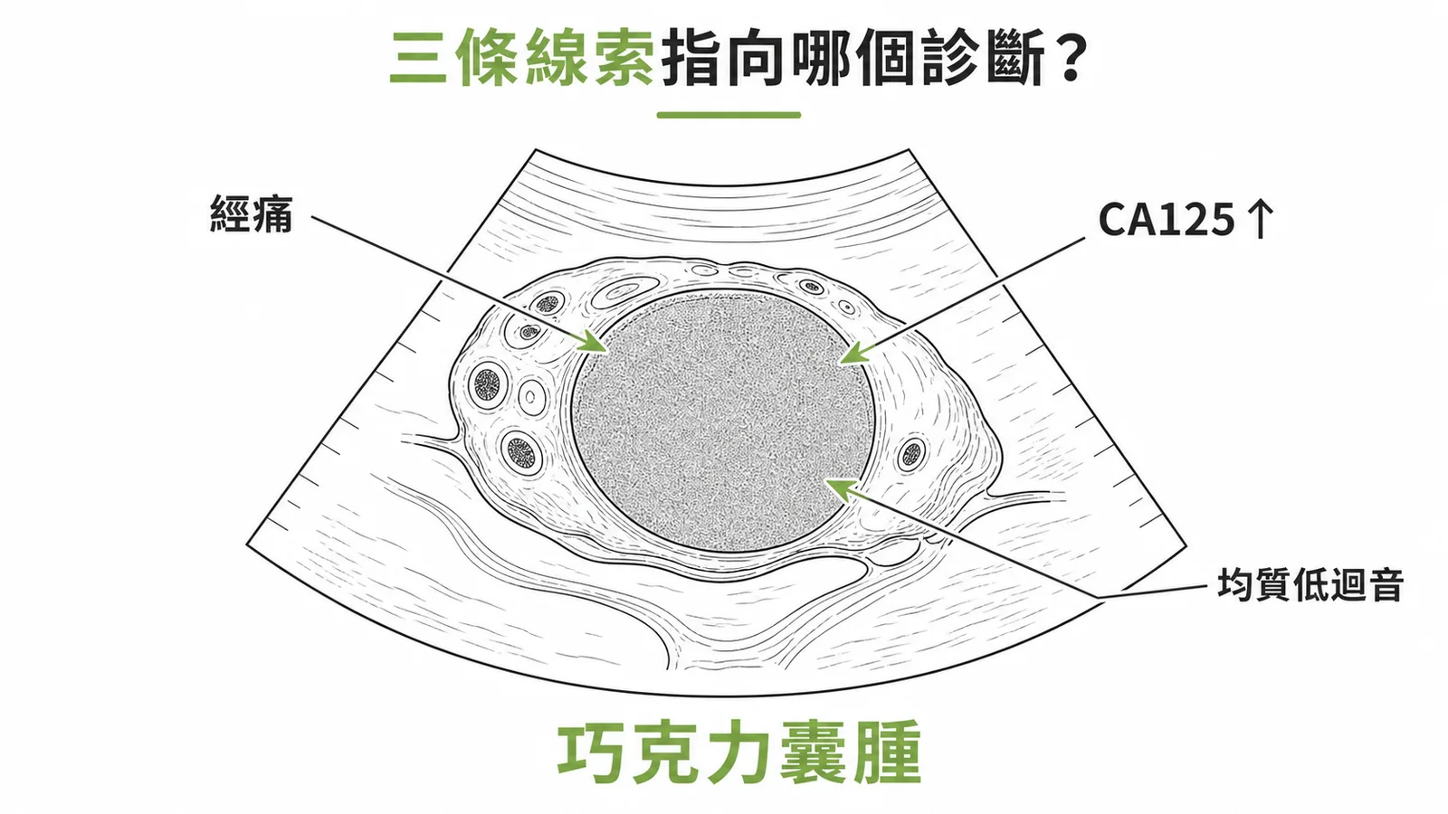 巧克力囊腫三大診斷線索示意圖