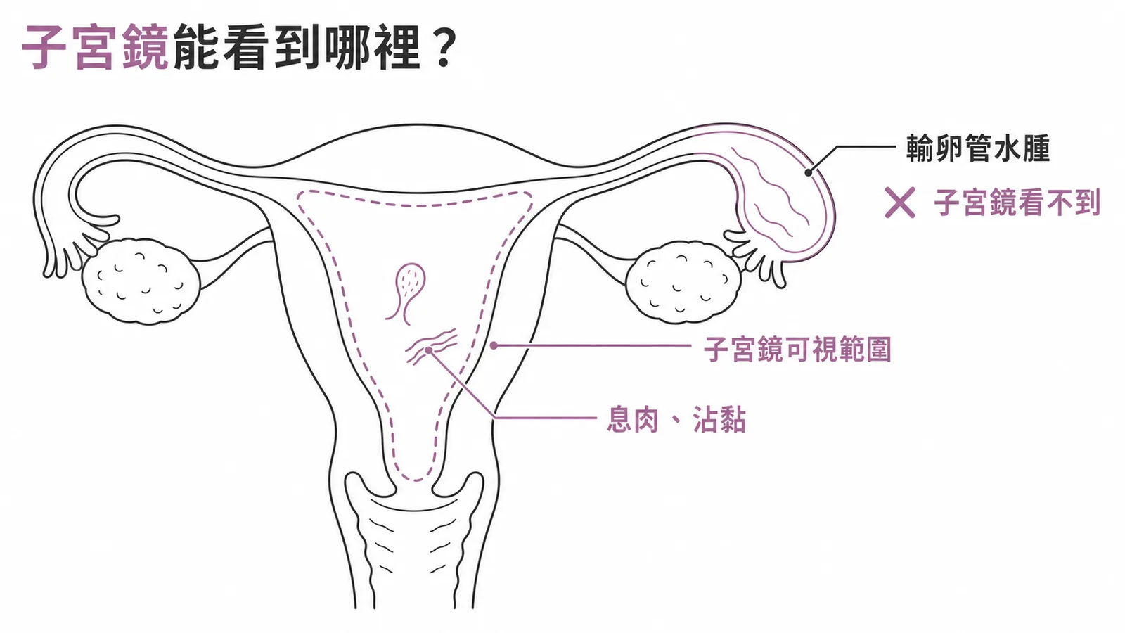 子宮鏡可視範圍與輸卵管水腫不可視示意圖